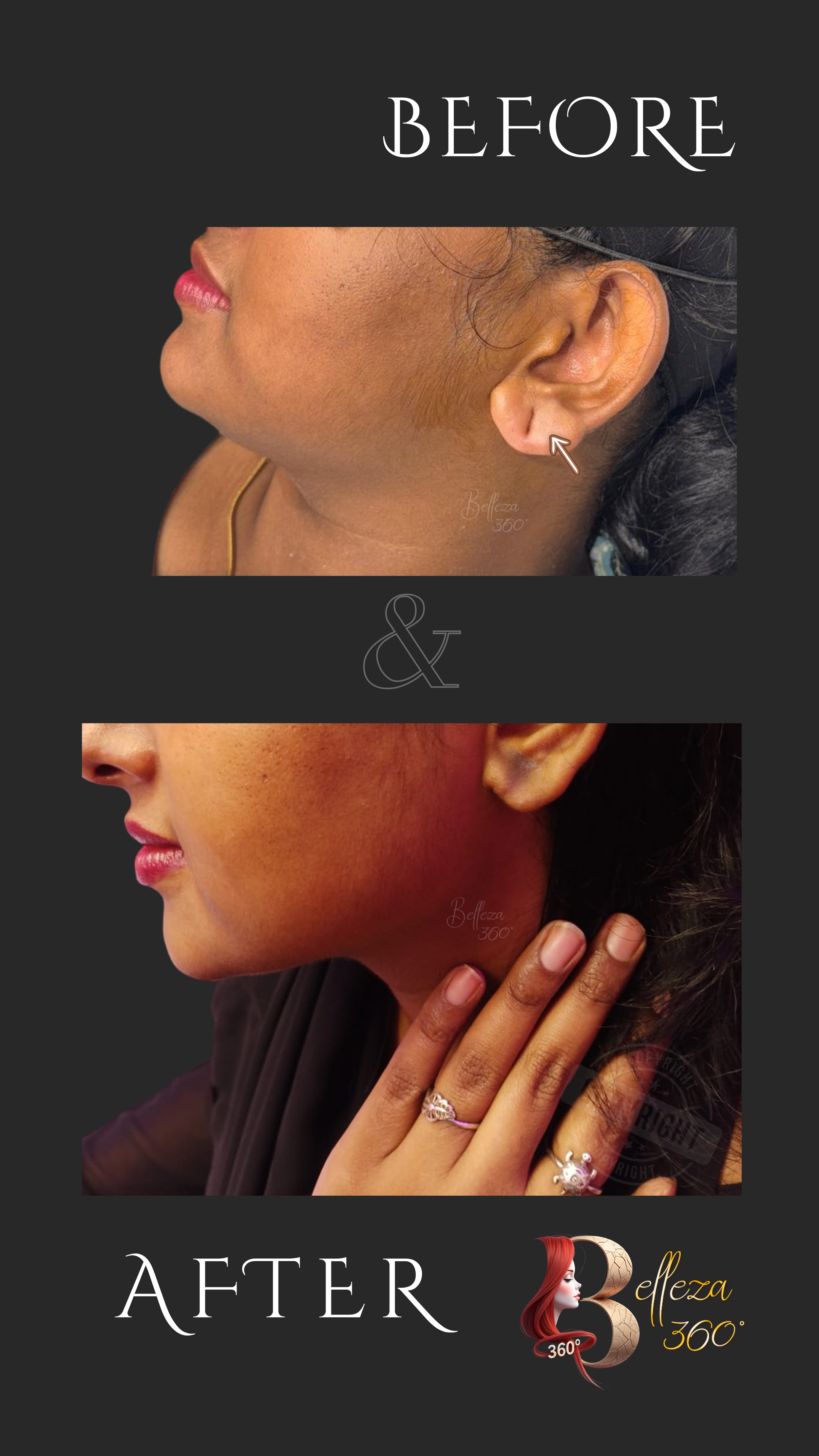 Earlobe repair Chennai, Torn earlobe correction Chennai, Non-surgical earlobe repair Chennai, Earlobe reconstruction Chennai, Cosmetic earlobe treatment Chennai, Best skin clinic in Chennai