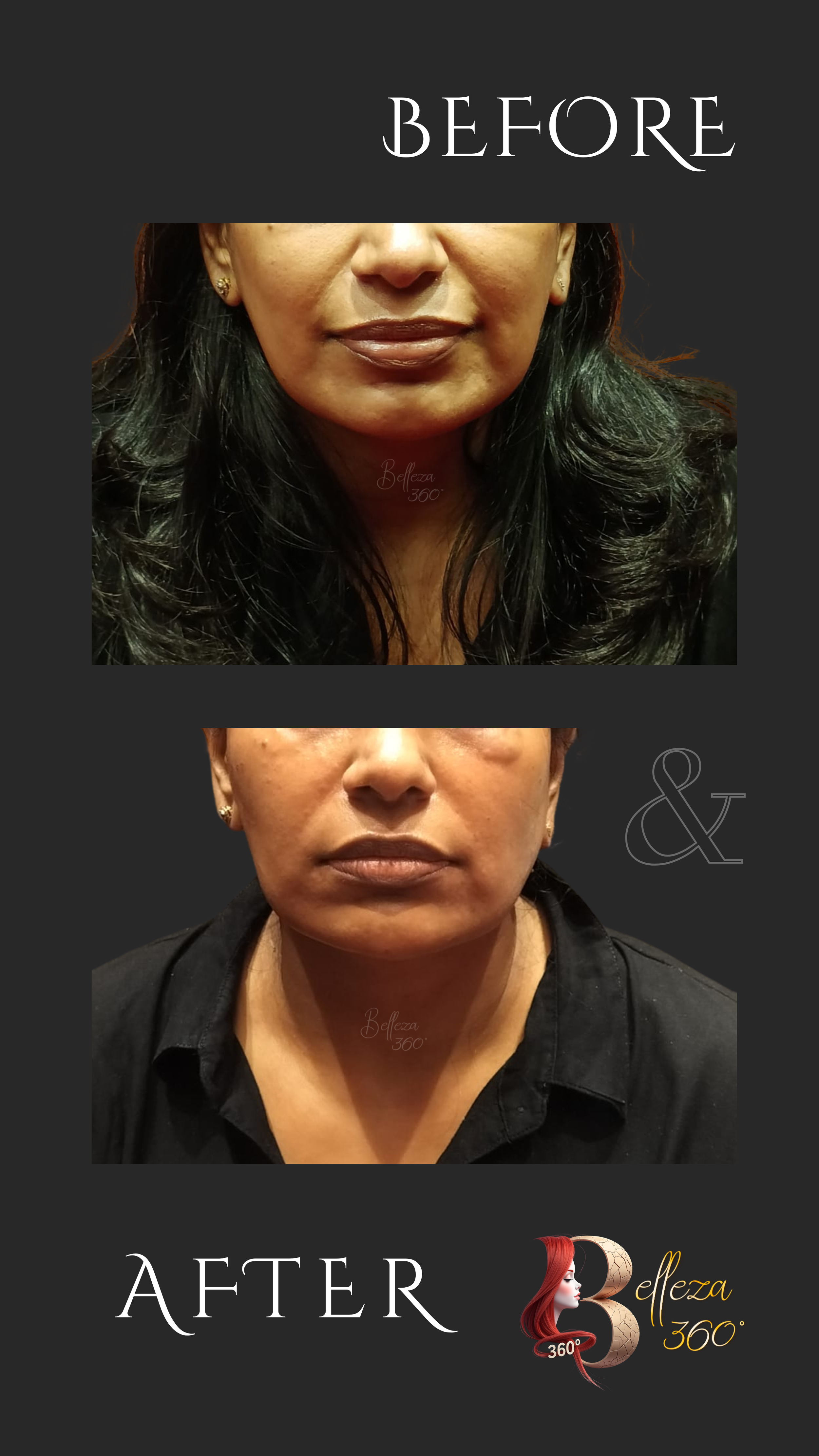 Mid face thread lift Chennai, Non-surgical mid face lift, Thread lift for cheeks, Mid face lifting treatment Chennai, Best thread lift clinic Chennai, Cheek lifting thread procedure