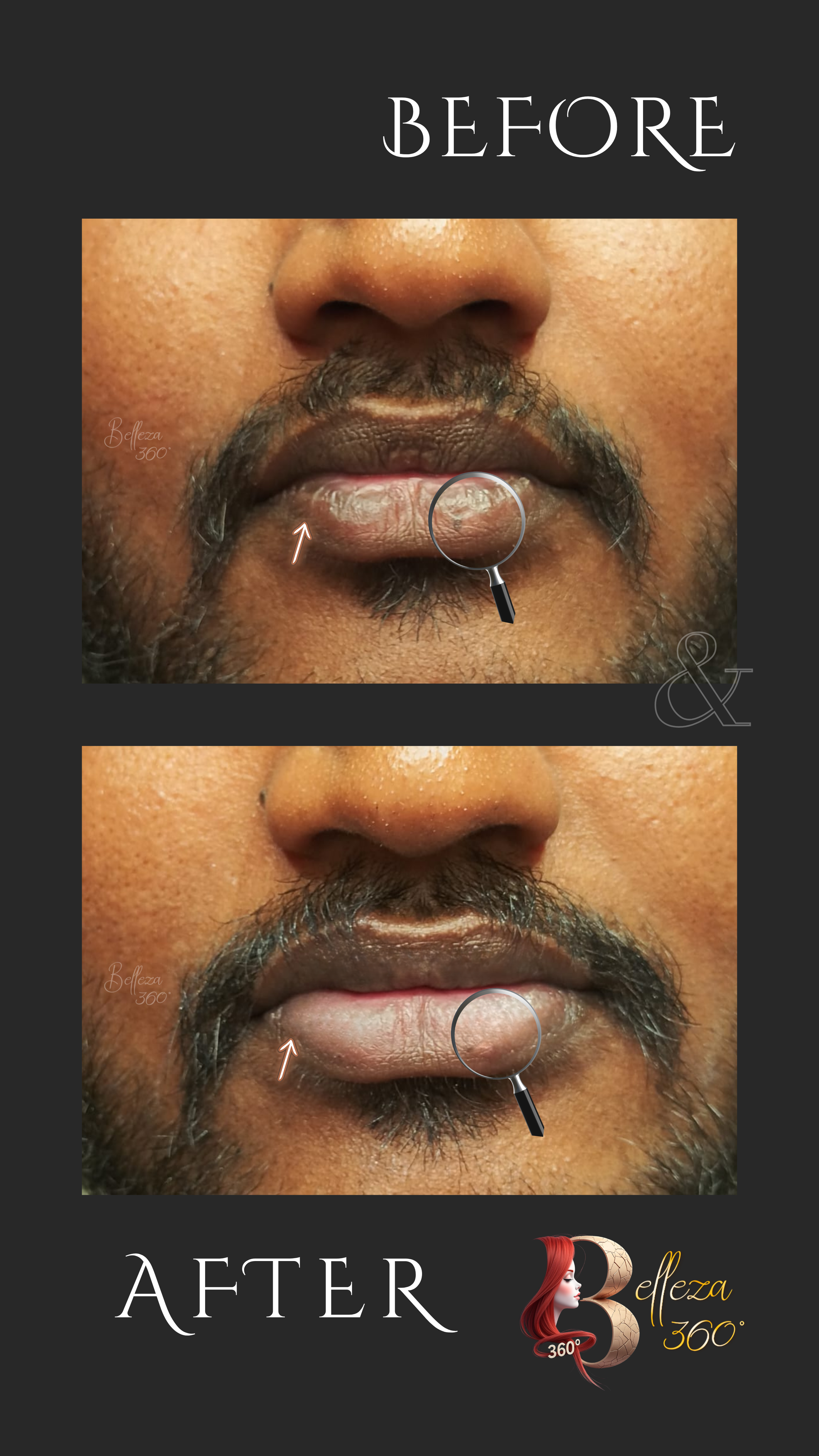 Laser lip lightening, Laser lip pigmentation treatment, Lip lightening treatment, Dark lips laser treatment, Laser lip color correction, Lip depigmentation laser treatment, Pink lips laser treatment, Lip lightening clinic