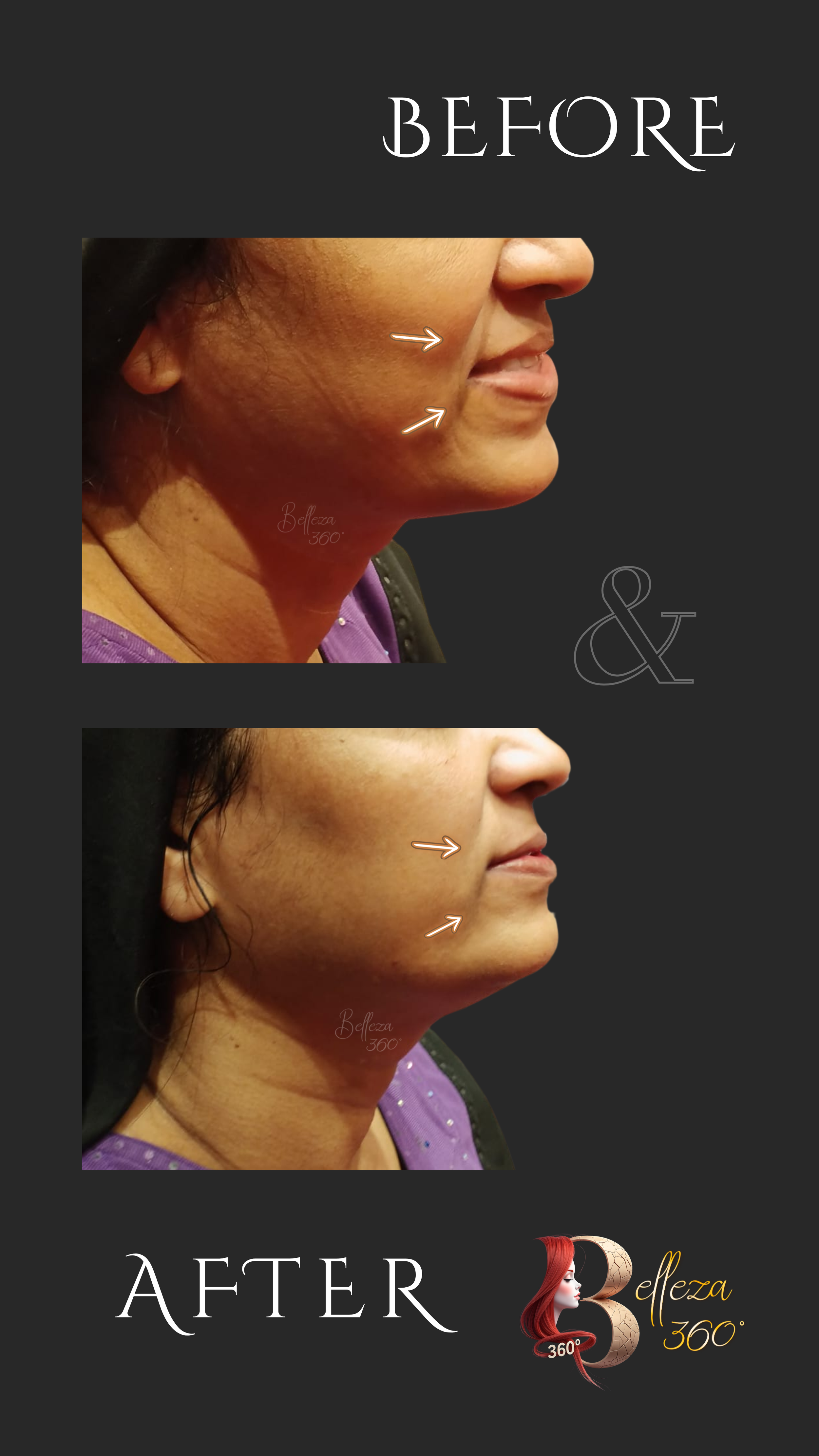 HIFU wrinkle softening in Chennai, HIFU anti-aging treatment Chennai, Non-surgical wrinkle reduction Chennai, HIFU skin tightening clinic Chennai, HIFU for fine lines Chennai, HIFU wrinkle treatment cost in Chennai