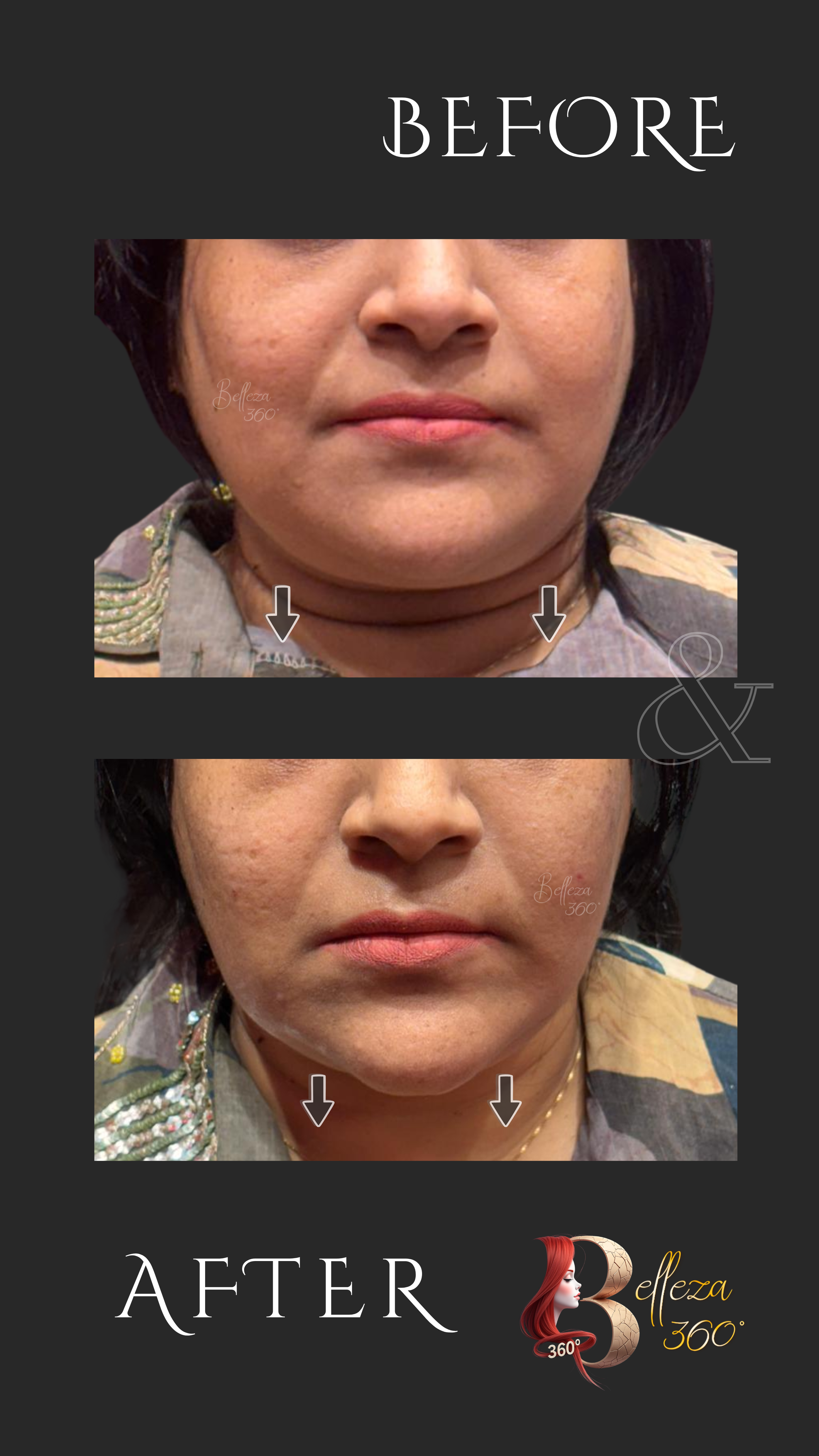 Chin elongation fillers Chennai, Chin augmentation Chennai, Non-surgical chin enhancement Chennai, Jawline contouring Chennai, Facial profile balancing Chennai, Best skin clinic in Chennai