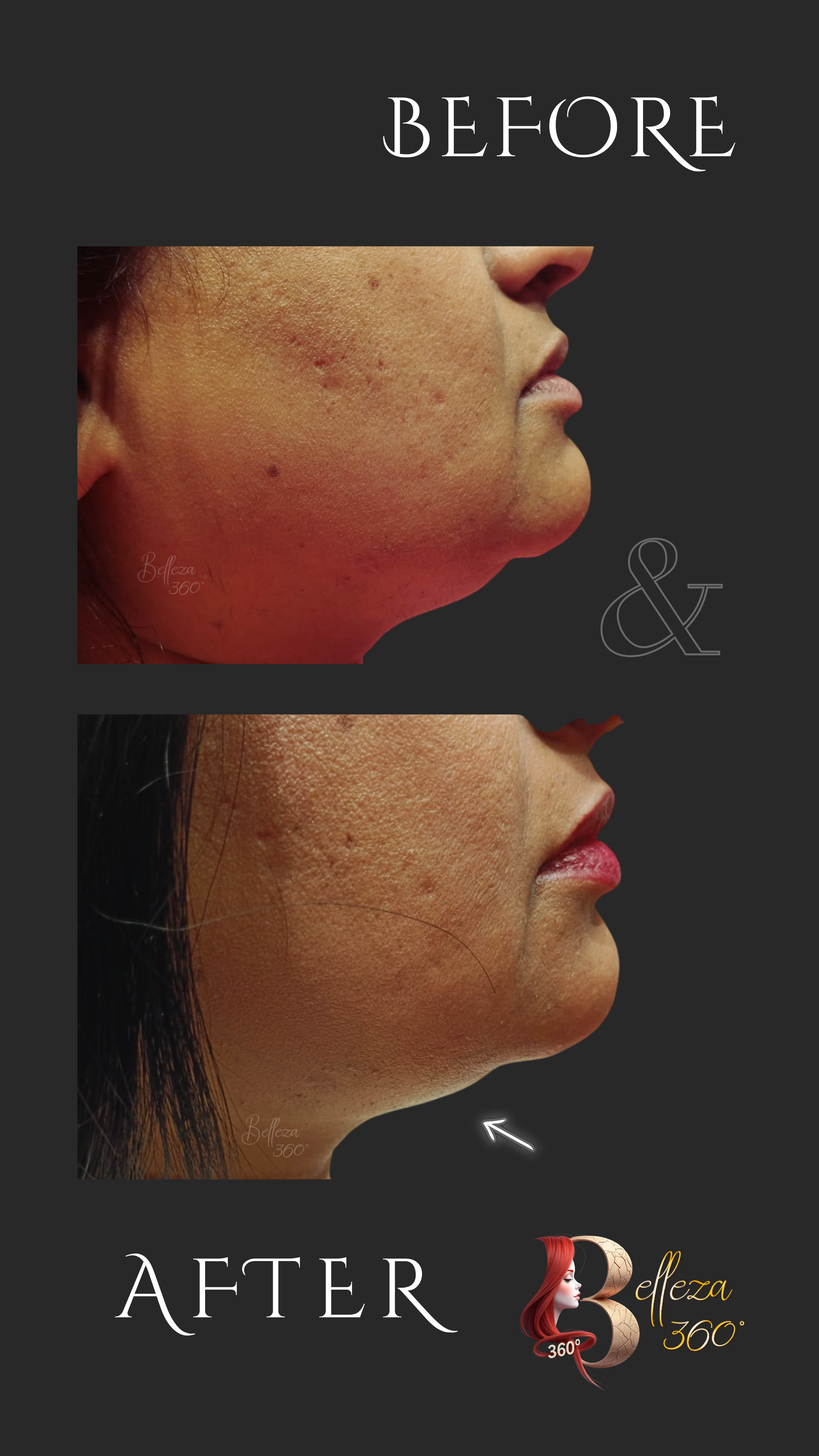 Double chin removal Chennai, HIFU chin reduction Chennai, Jawline contouring Chennai, Neck tightening Chennai, Non-surgical double chin Chennai, Best skin clinic in Chennai
