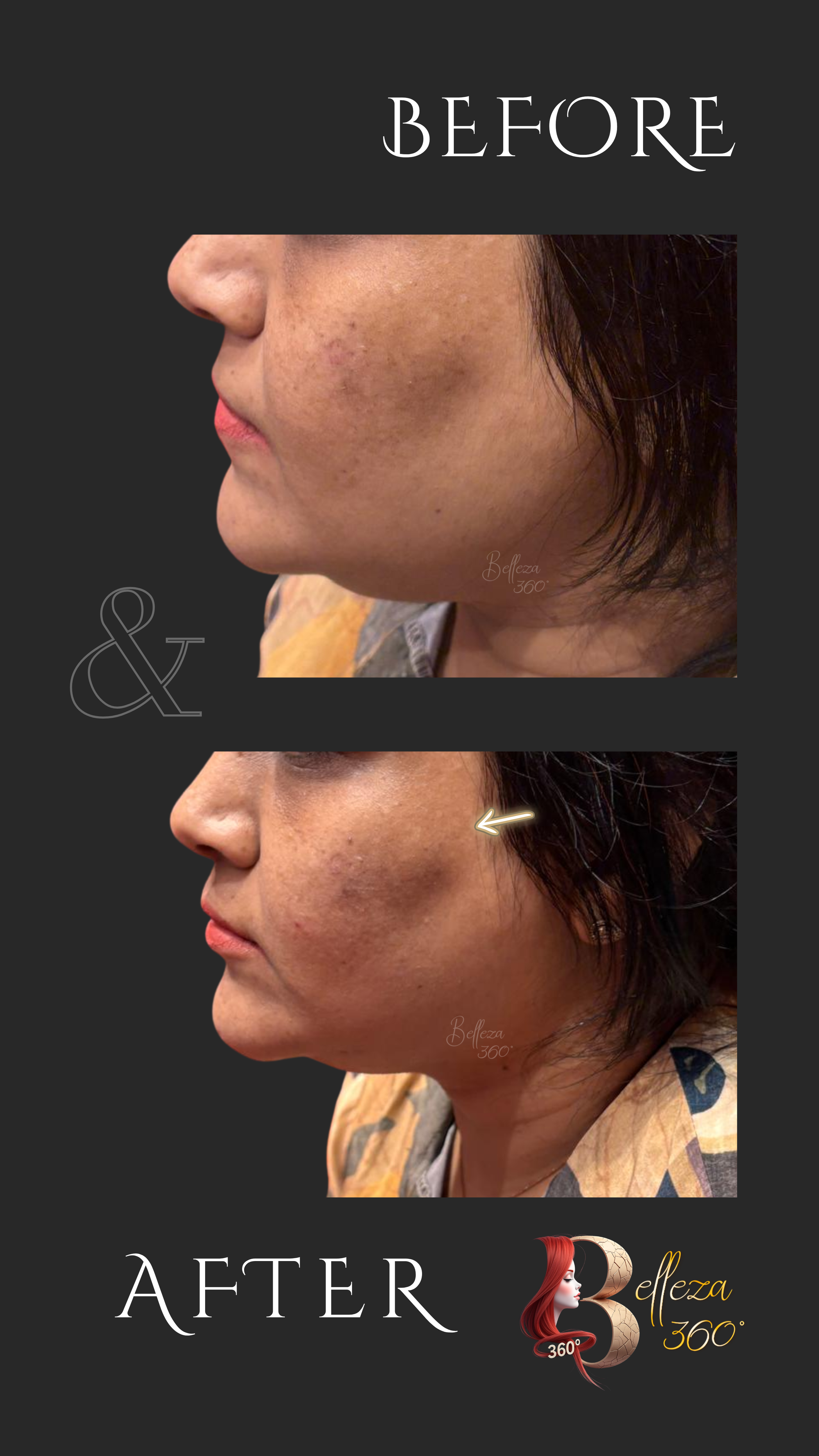Mid face volumization in Chennai, Best mid face filler treatment Chennai, Non-surgical mid face volumization Chennai, Mid face rejuvenation clinic Chennai, Mid face volumization cost in Chennai, Dermal fillers for mid face Chennai