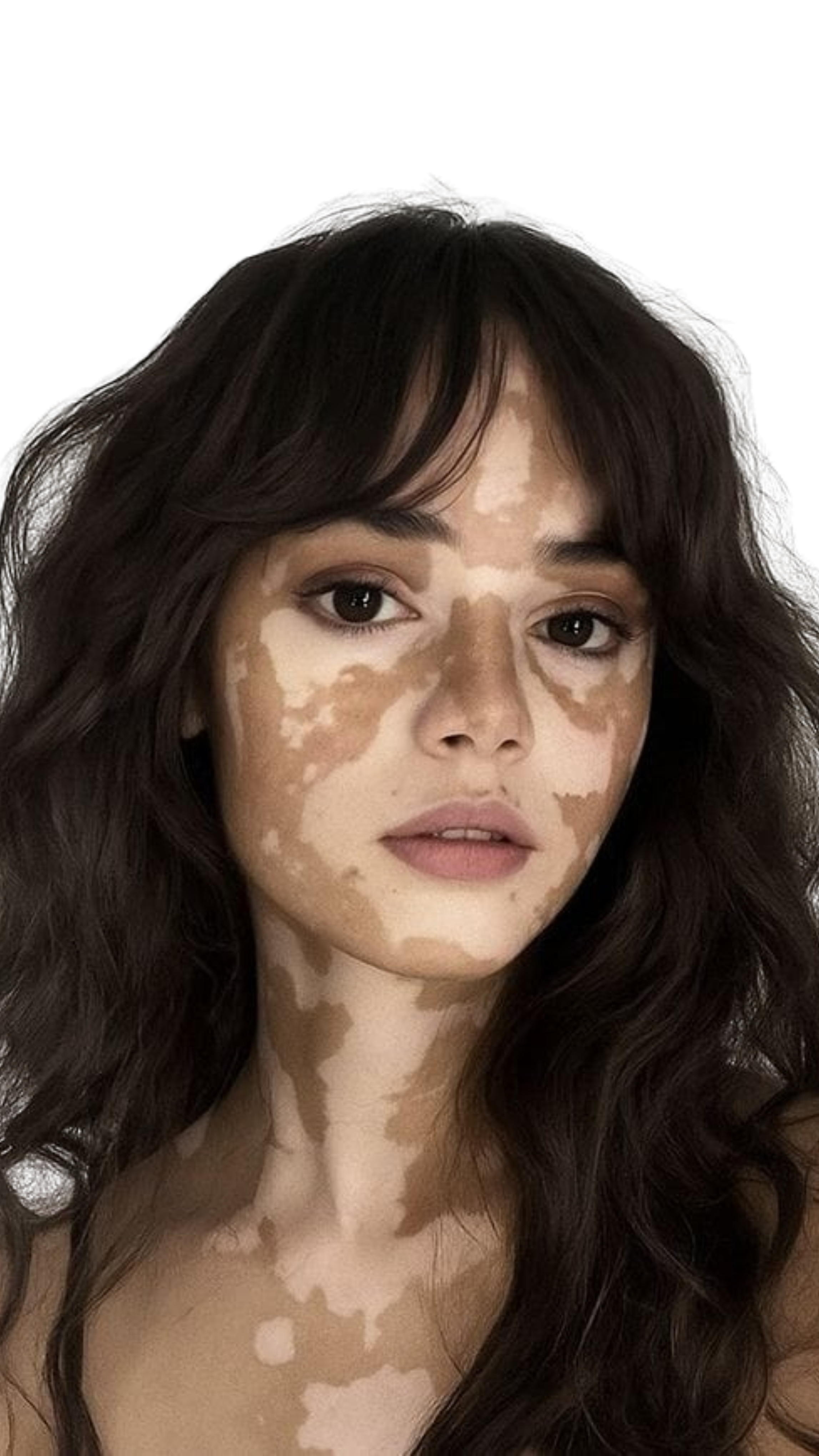 Vitiligo treatment in Chennai, Best skin clinic in Chennai for vitiligo, Vitiligo specialist in Chennai, White patch treatment Chennai, Vitiligo dermatologist Chennai, Advanced vitiligo care Chennai