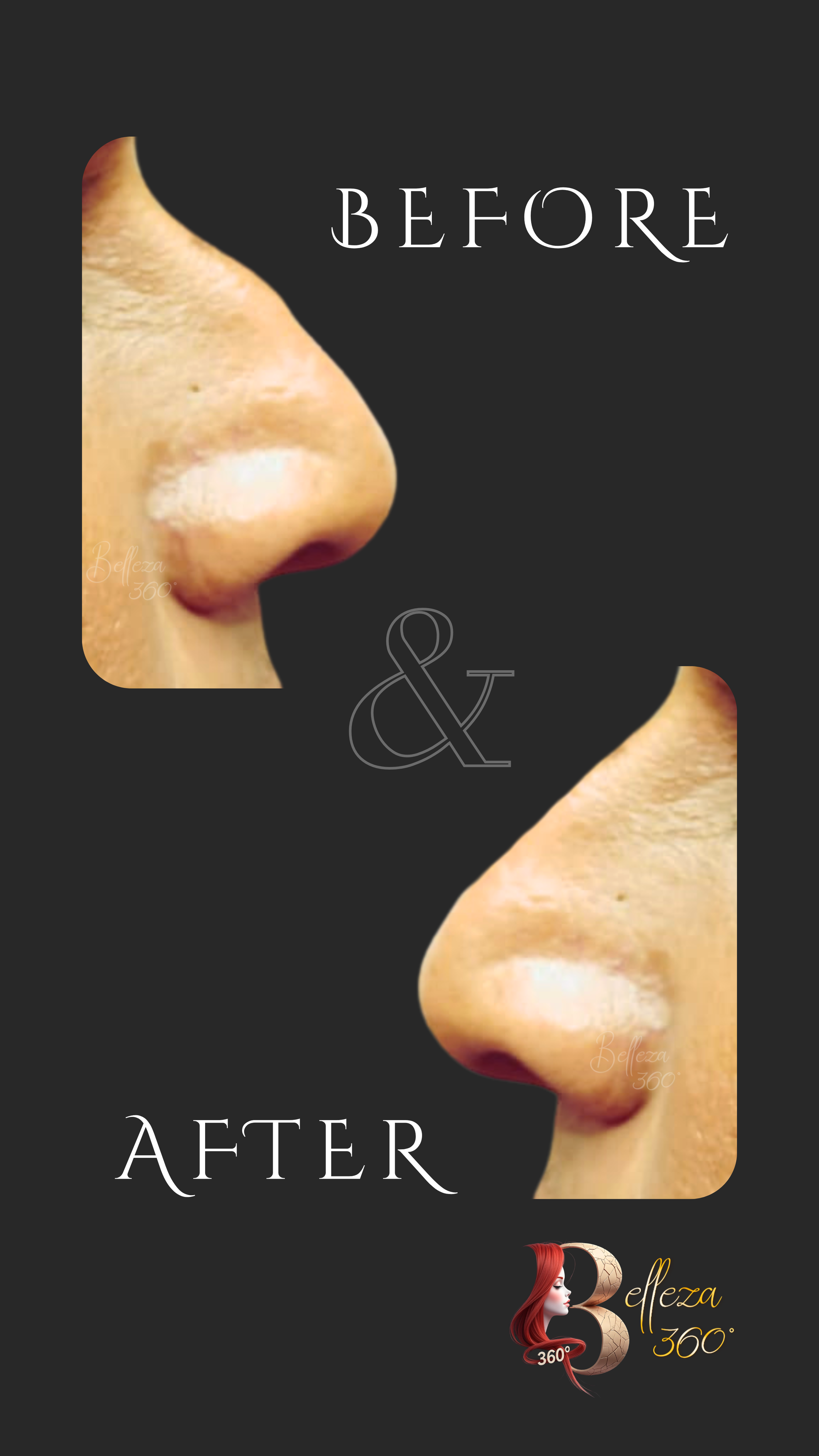 Non-surgical nose shaping Chennai, Nose filler treatment Chennai, Non-surgical rhinoplasty Chennai, Nose contouring clinic Chennai, Dermal nose reshaping Chennai, Best skin clinic in Chennai