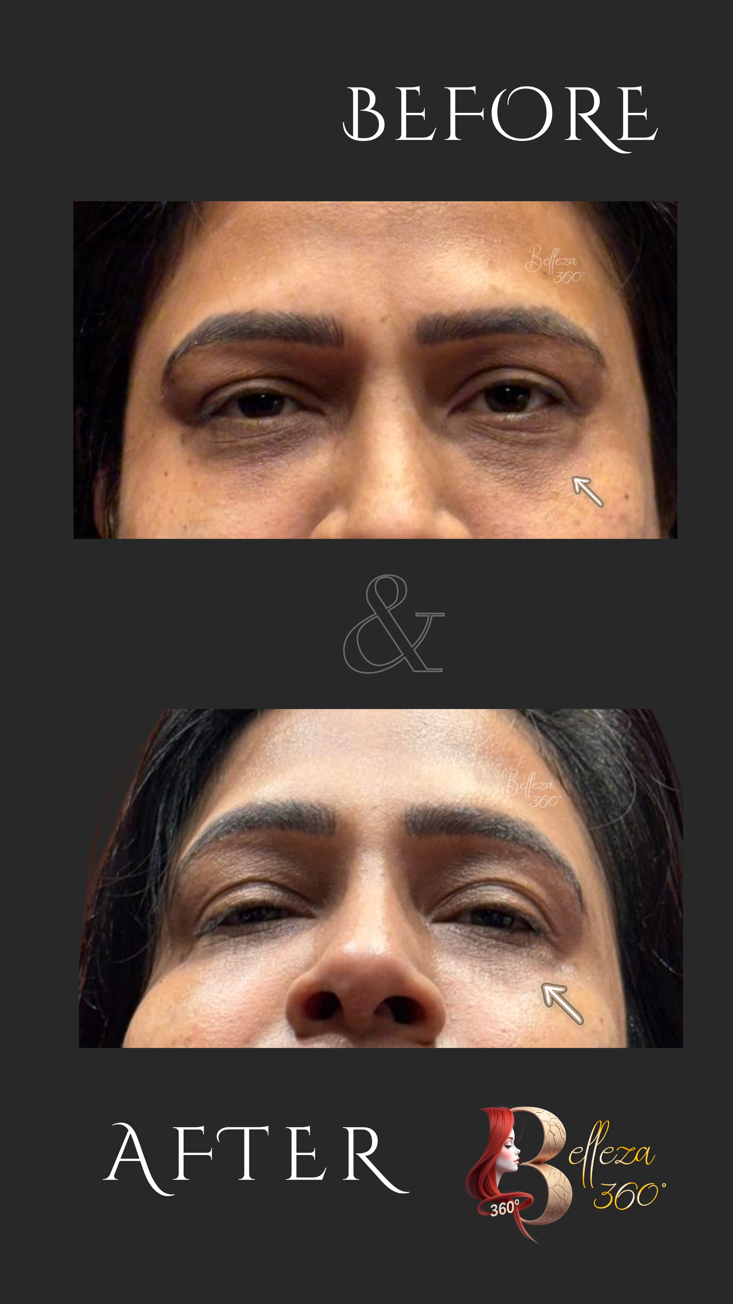 Undereye fillers Chennai, Tear trough fillers Chennai, Dark circle treatment Chennai, Eye bag correction Chennai, Non-surgical under eye rejuvenation Chennai, Best skin clinic in Chennai