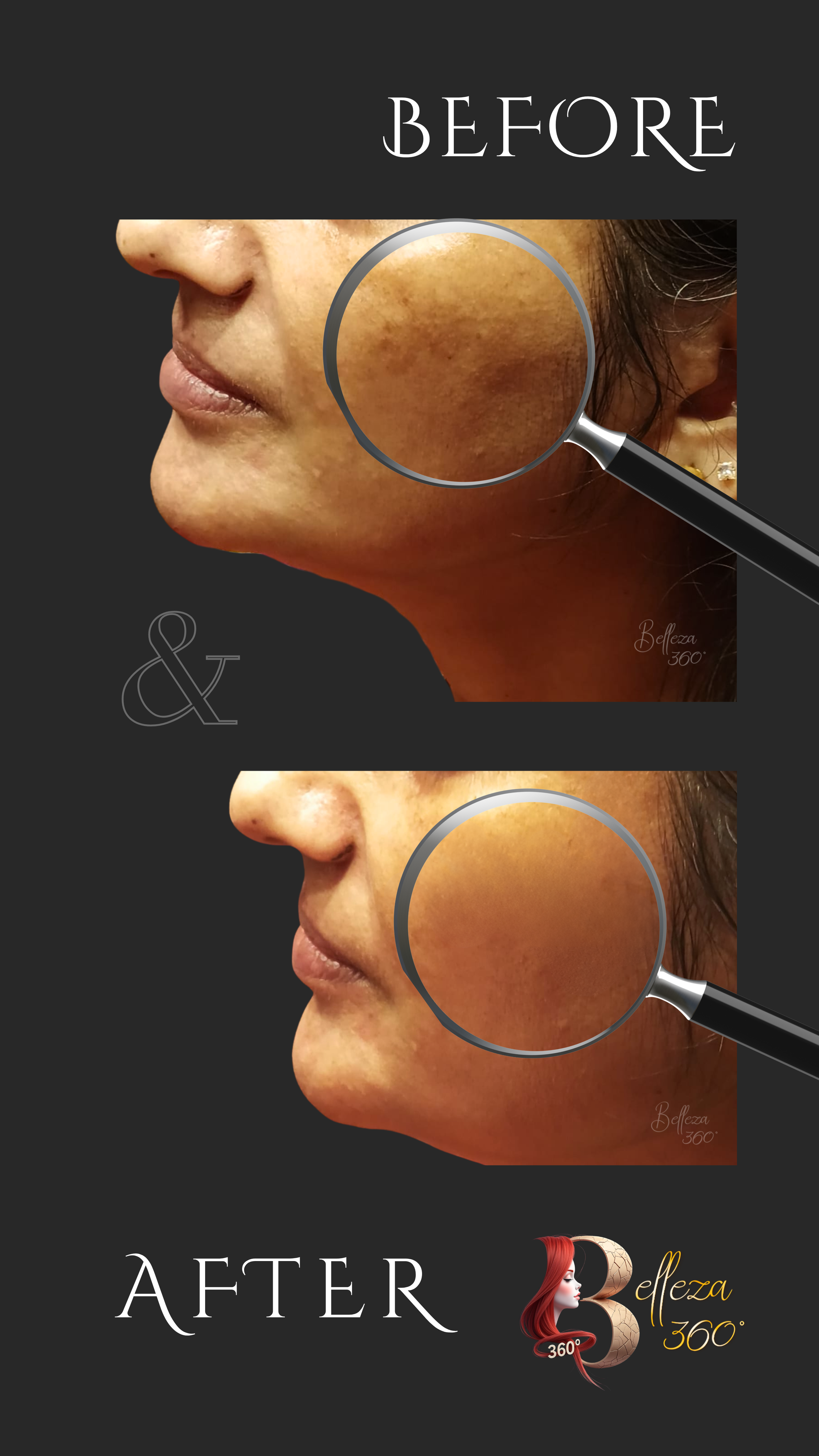 Melasma laser treatment in Chennai, Laser lightening for melasma Chennai, Best melasma clinic in Chennai, Melasma removal laser Chennai, Painless melasma laser treatment Chennai, Melasma laser lightening cost in Chennai