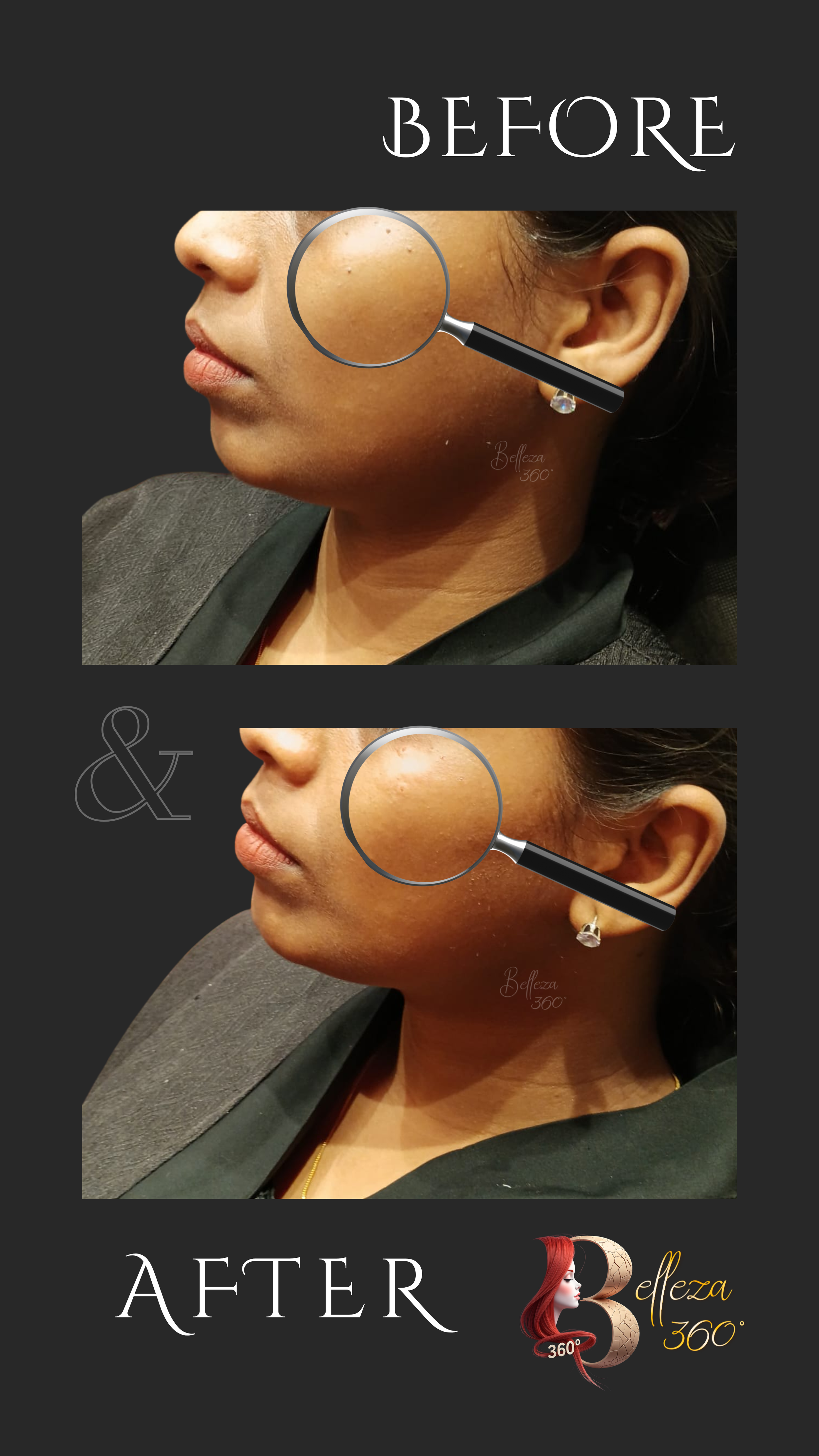 Skin tag removal Plasma Pen in Chennai, Plasma Pen treatment for skin tags Chennai, Best skin tag clinic Chennai, Non-surgical skin tag removal Chennai, Plasma Pen skin tag cost Chennai, Painless skin tag removal Chennai