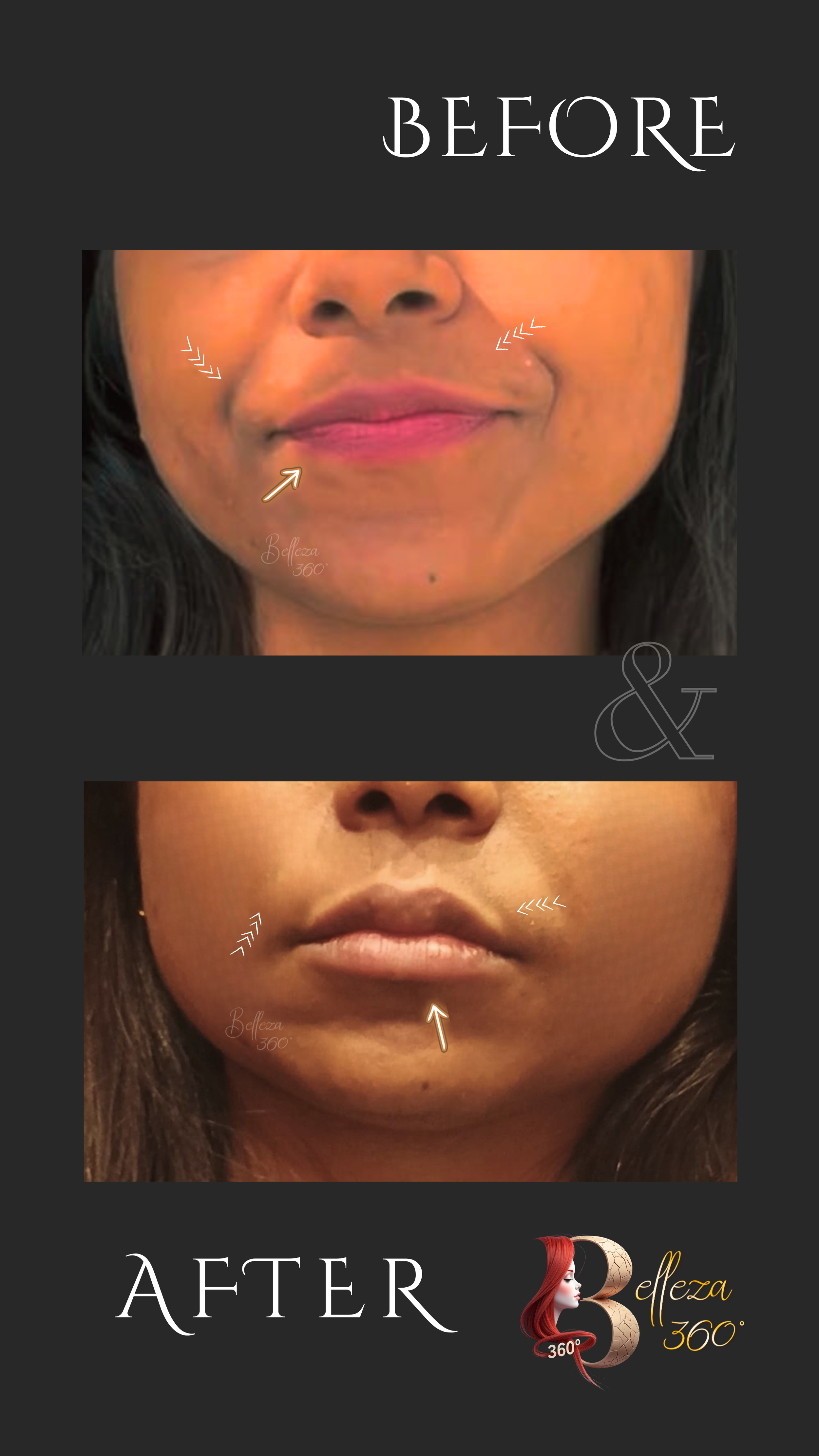 Subtle lip filler Chennai, Natural lip enhancement Chennai, Lip augmentation clinic Chennai, Non-surgical lip filler Chennai, Soft lip plumping Chennai, Best skin clinic in Chennai