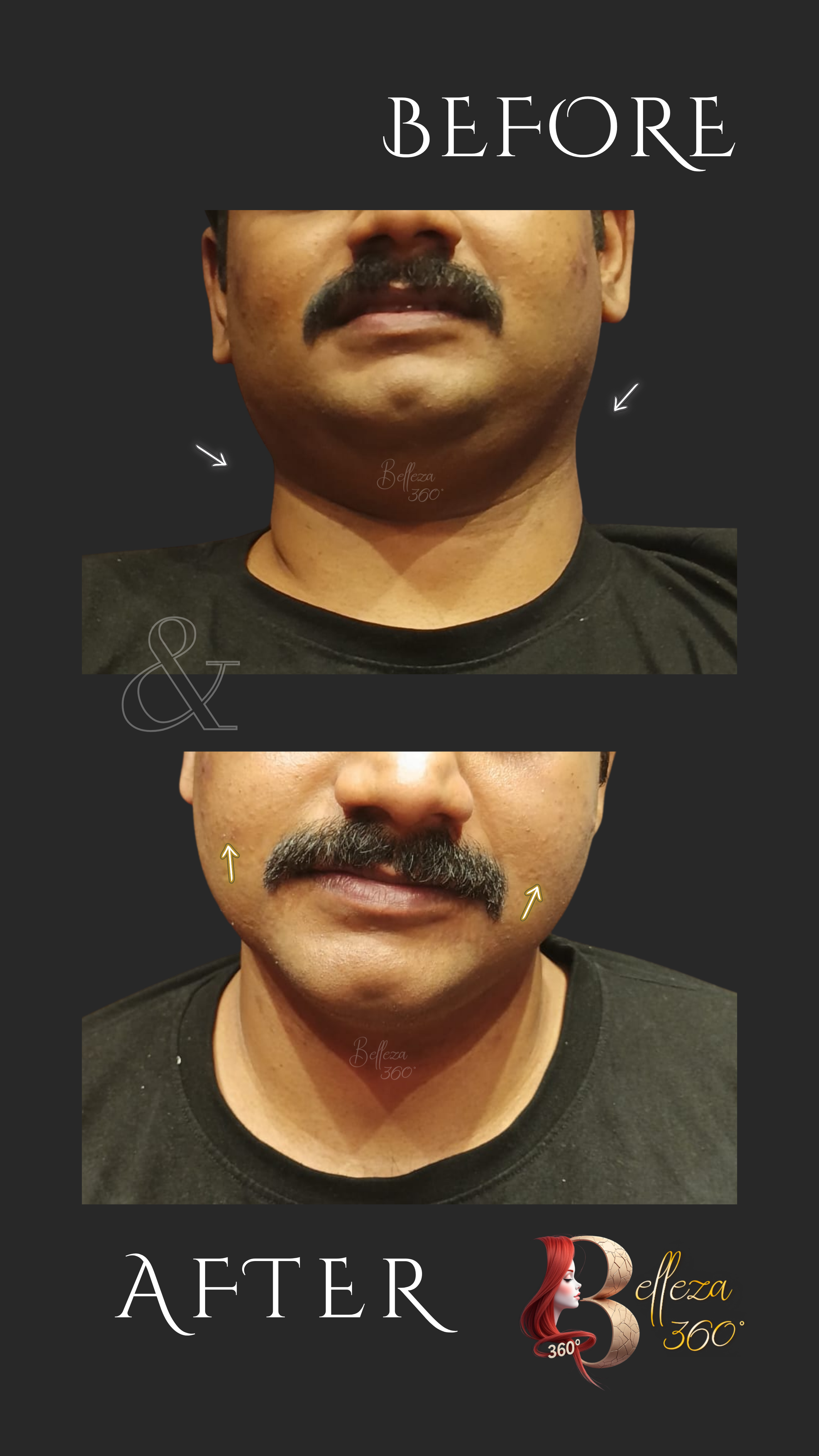 Ultraformer MPT facelift Chennai, Non-surgical facelift Chennai, Skin lifting treatment Chennai, Wrinkle reduction Chennai, Face tightening clinic Chennai, Best skin clinic in Chennai