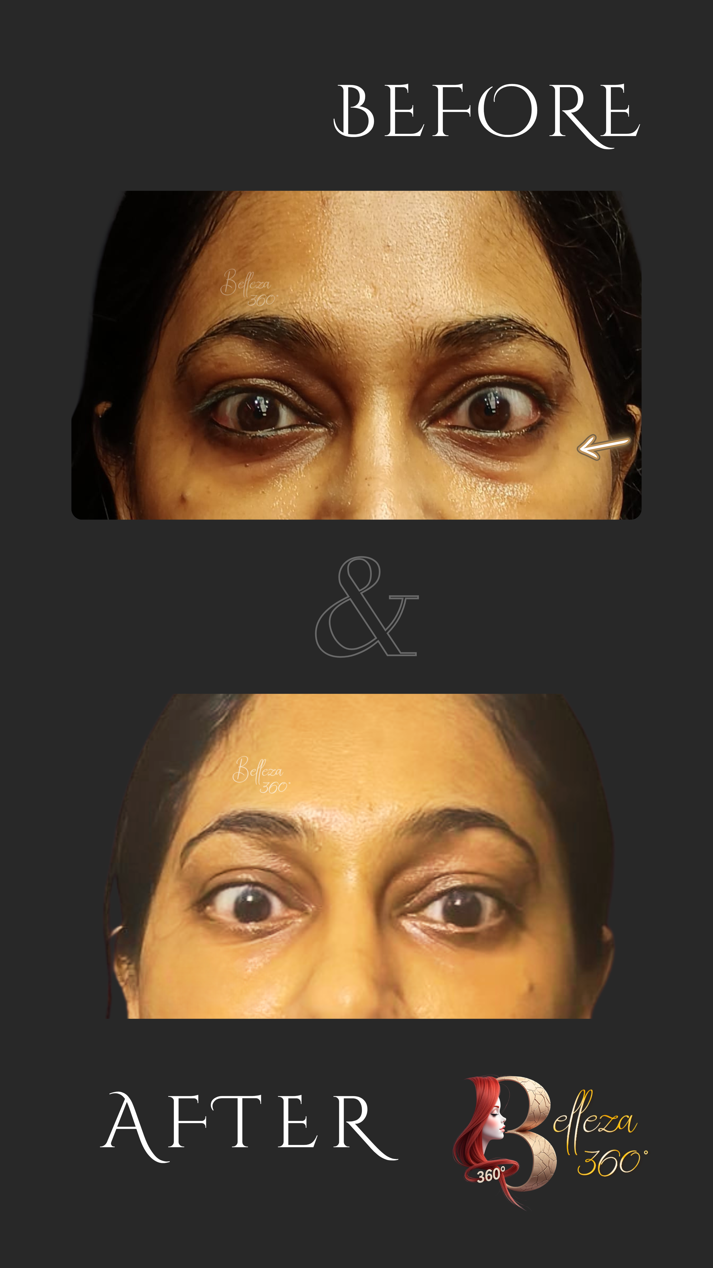 Eye Exilis treatment, PDRN booster therapy, undereye skin rejuvenation, best undereye tightening treatment, Exilis and PDRN for dark circles, dermatologist for undereye boosters