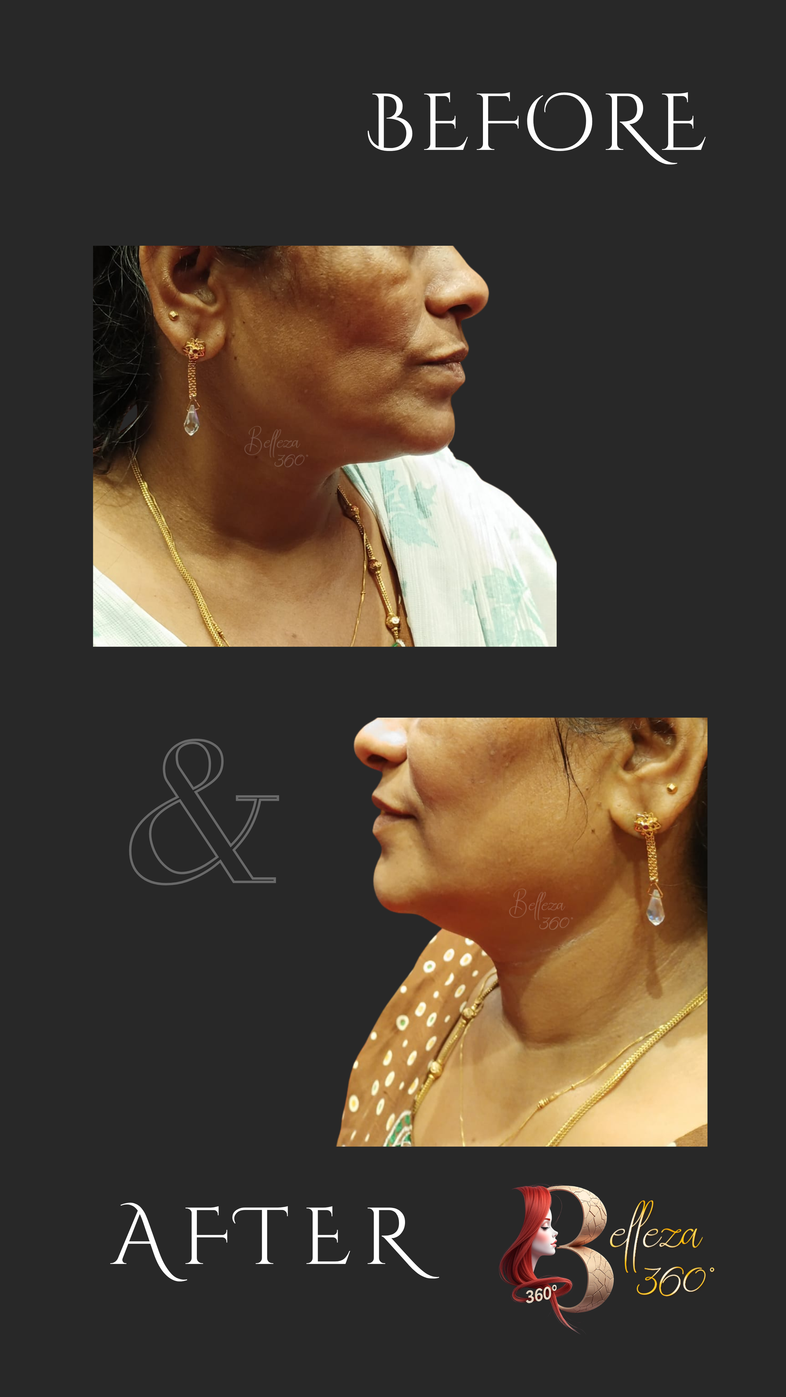 IV glutathione skin whitening Chennai, Glutathione therapy Chennai, Skin brightening IV Chennai, Non-surgical skin lightening Chennai, Radiant skin treatment Chennai, Best skin clinic in Chennai