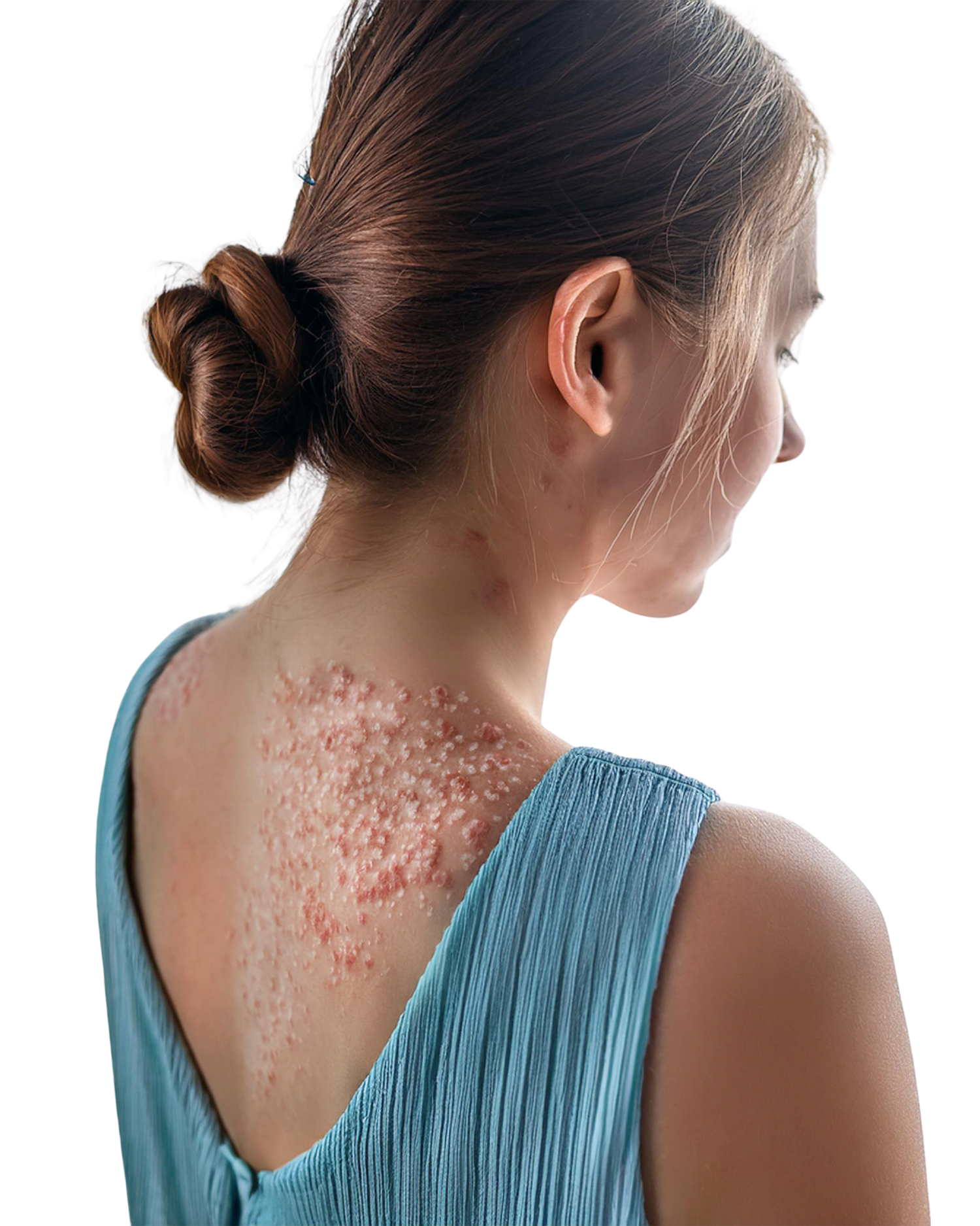Atopic dermatitis treatment in Chennai, Eczema specialist in Chennai, Best skin clinic in Chennai for atopic dermatitis, Atopic dermatitis dermatologist Chennai, Chronic eczema treatment Chennai, Skin clinic for eczema in Chennai