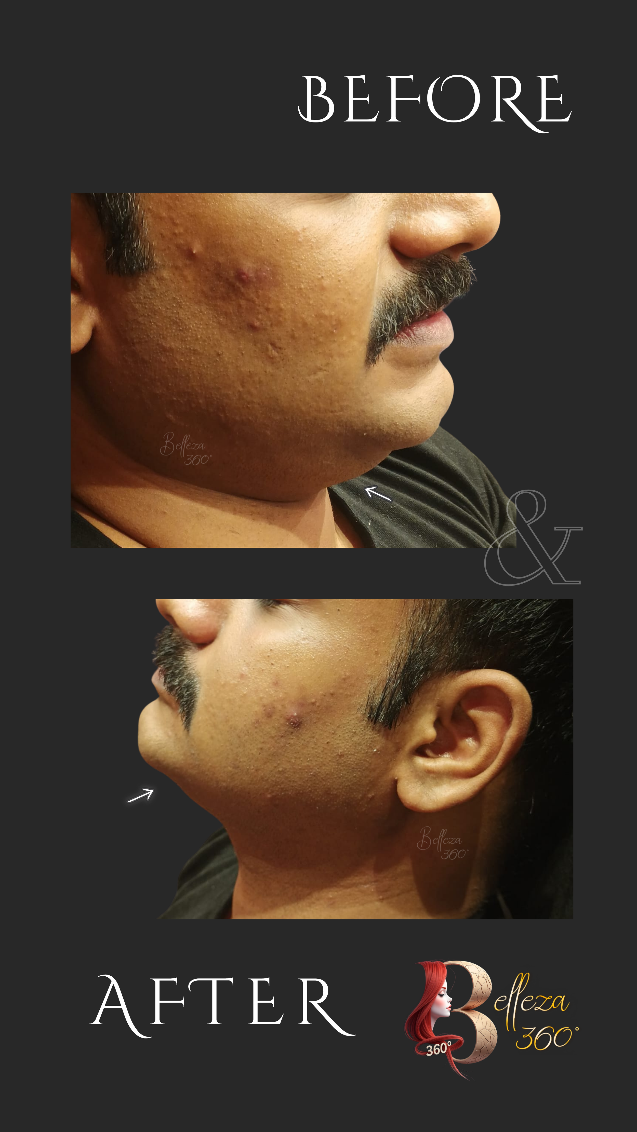 Ultraformer MPT neck treatment in Chennai, Neck lifting with Ultraformer MPT Chennai, Non-surgical neck tightening Chennai, Ultraformer MPT skin tightening clinic Chennai, Neck rejuvenation Ultraformer MPT Chennai, Ultraformer MPT neck tightening cos
