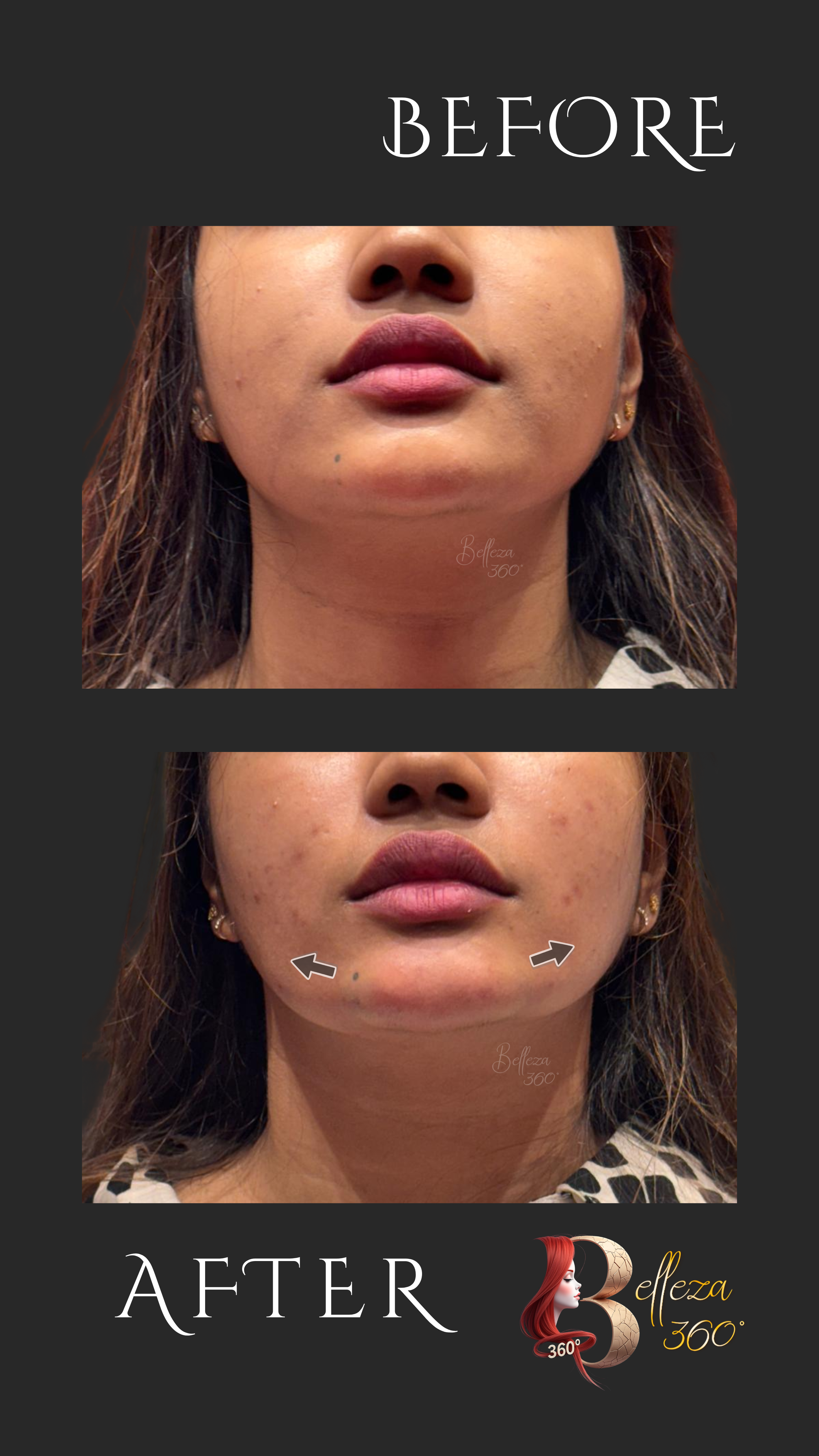 Filler jawline sculpting in Chennai, Jawline filler treatment Chennai, Non-surgical jawline contouring Chennai, Best jawline sculpting clinic Chennai, Jawline filler cost in Chennai, Dermal fillers for jawline Chennai