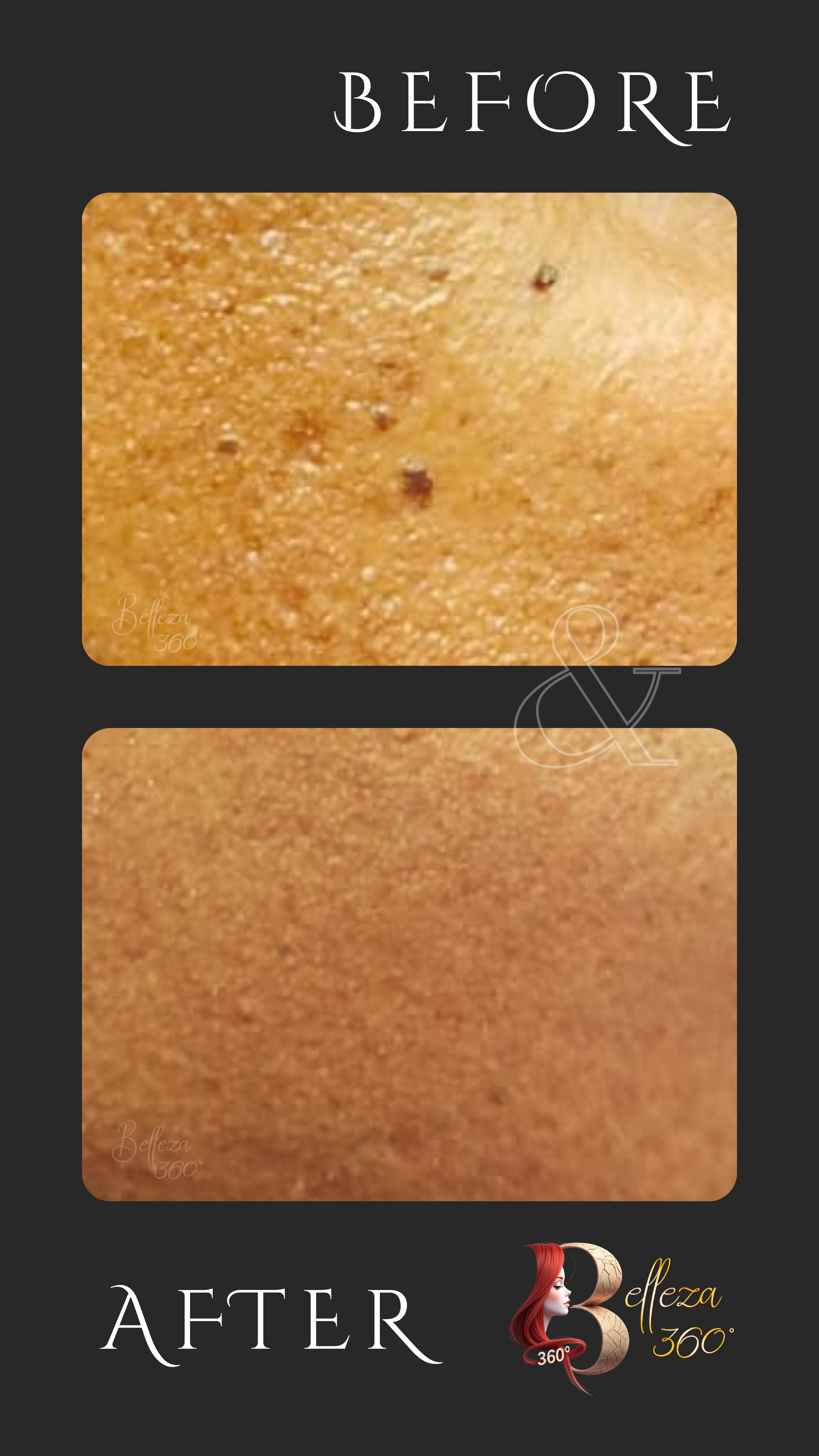 Skin tag removal in Chennai, Best skin tag removal clinic in Chennai, Laser skin tag removal Chennai, Skin tag removal cost in Chennai, Dermatologist for skin tag removal in Chennai, Painless skin tag removal Chennai