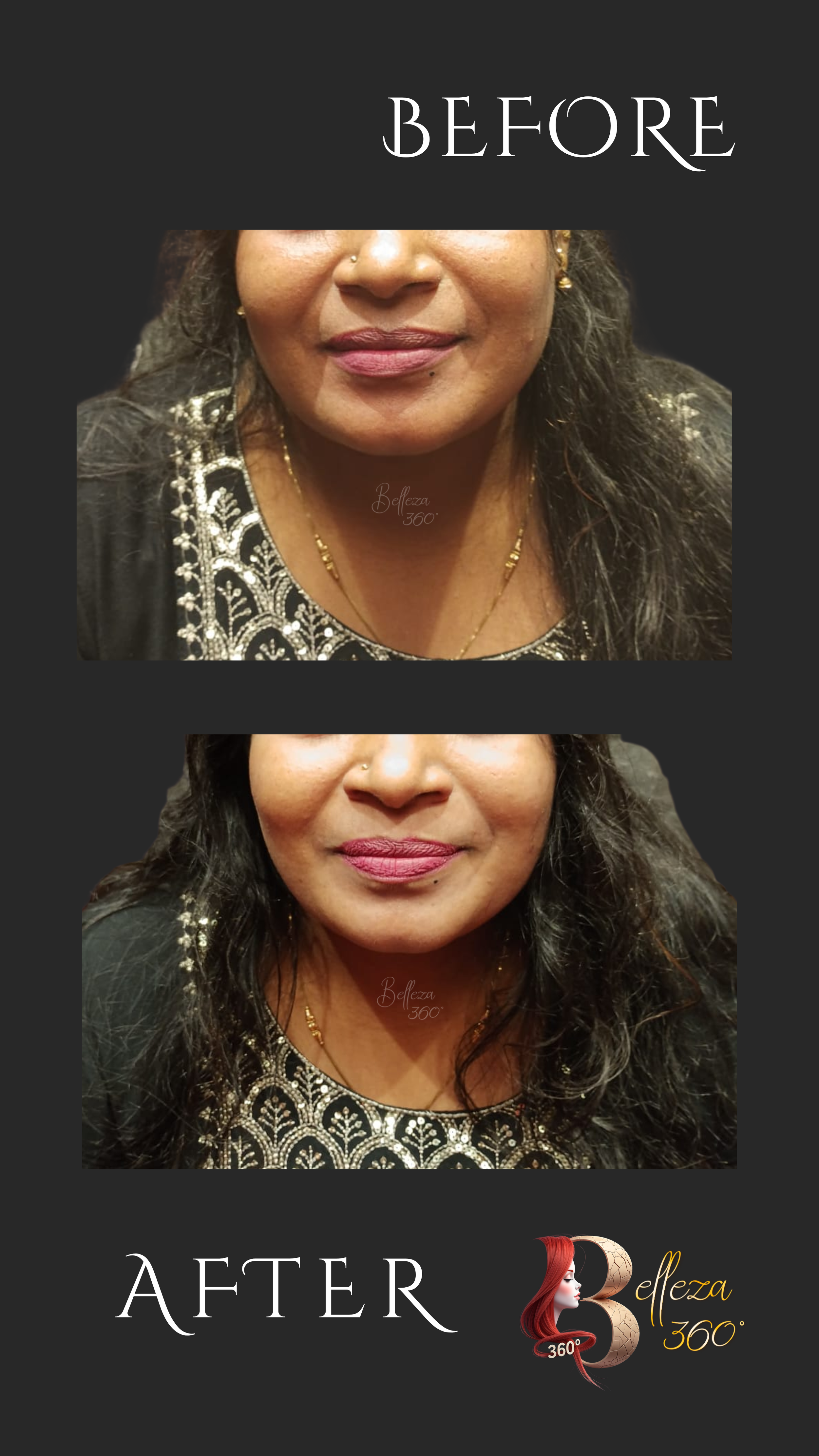 HydraFacial treatment in Chennai, Best HydraFacial clinic Chennai, HydraFacial skin cleansing Chennai, HydraFacial for glowing skin Chennai, HydraFacial cost in Chennai, Painless HydraFacial treatment Chennai