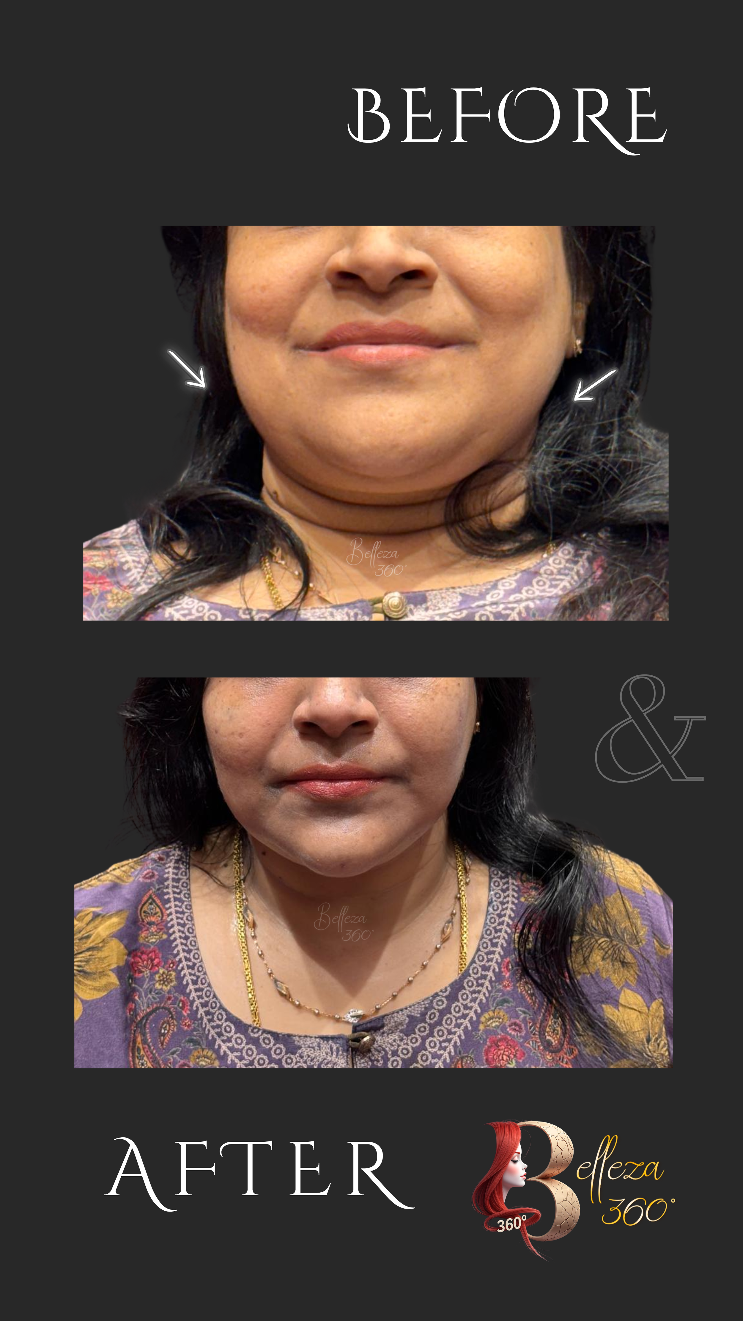 HIFU jawline sculpting Chennai, Best HIFU treatment in Chennai, Jawline contouring clinic Chennai, Non-surgical jawline sculpting Chennai, HIFU skin tightening Chennai, Best skin clinic in Chennai