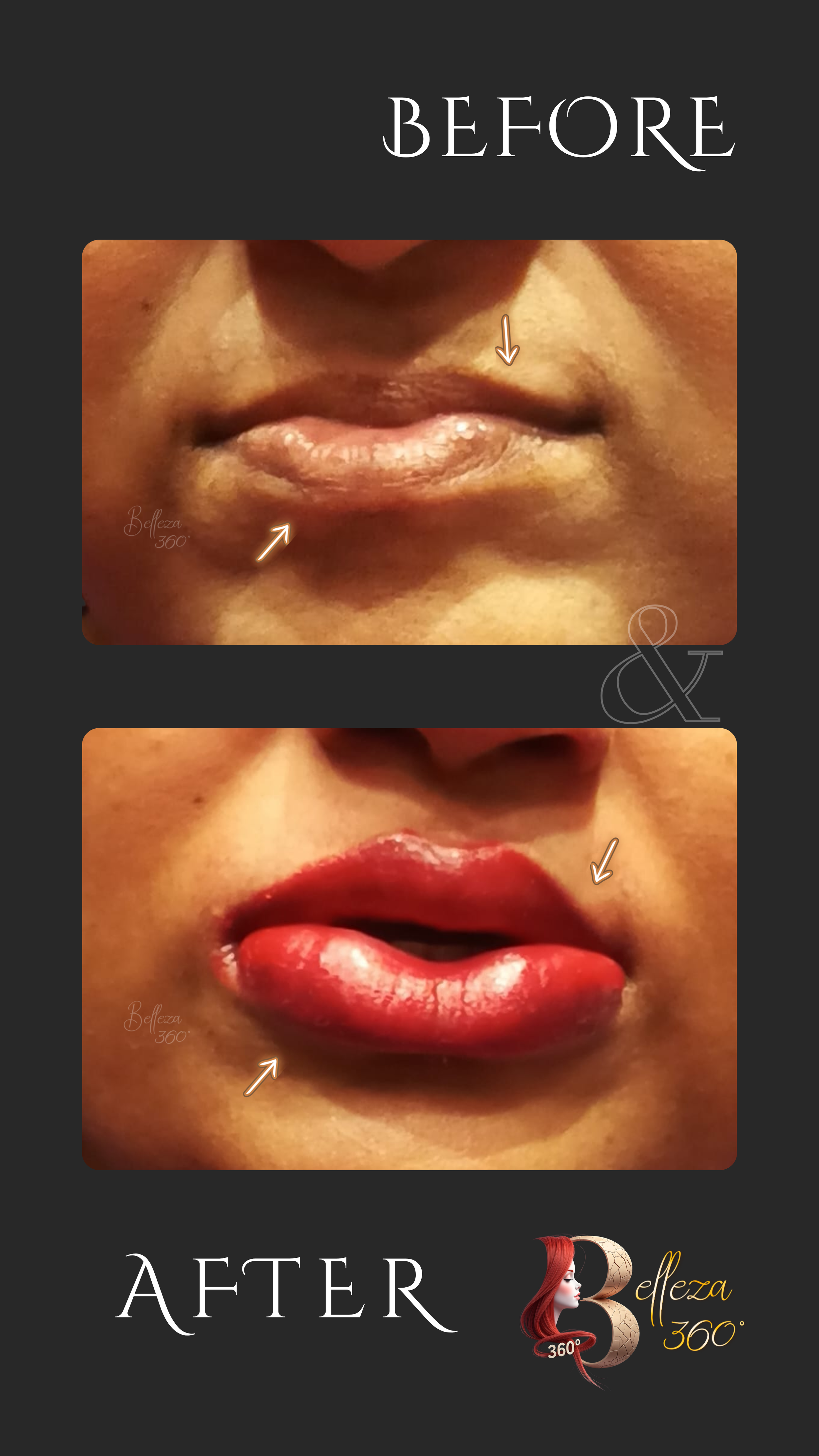 Lip blushing Chennai, Lip fillers Chennai, Non-surgical lip enhancement, Natural lip blushing treatment, Best lip fillers clinic Chennai, Lip pigmentation correction Chennai