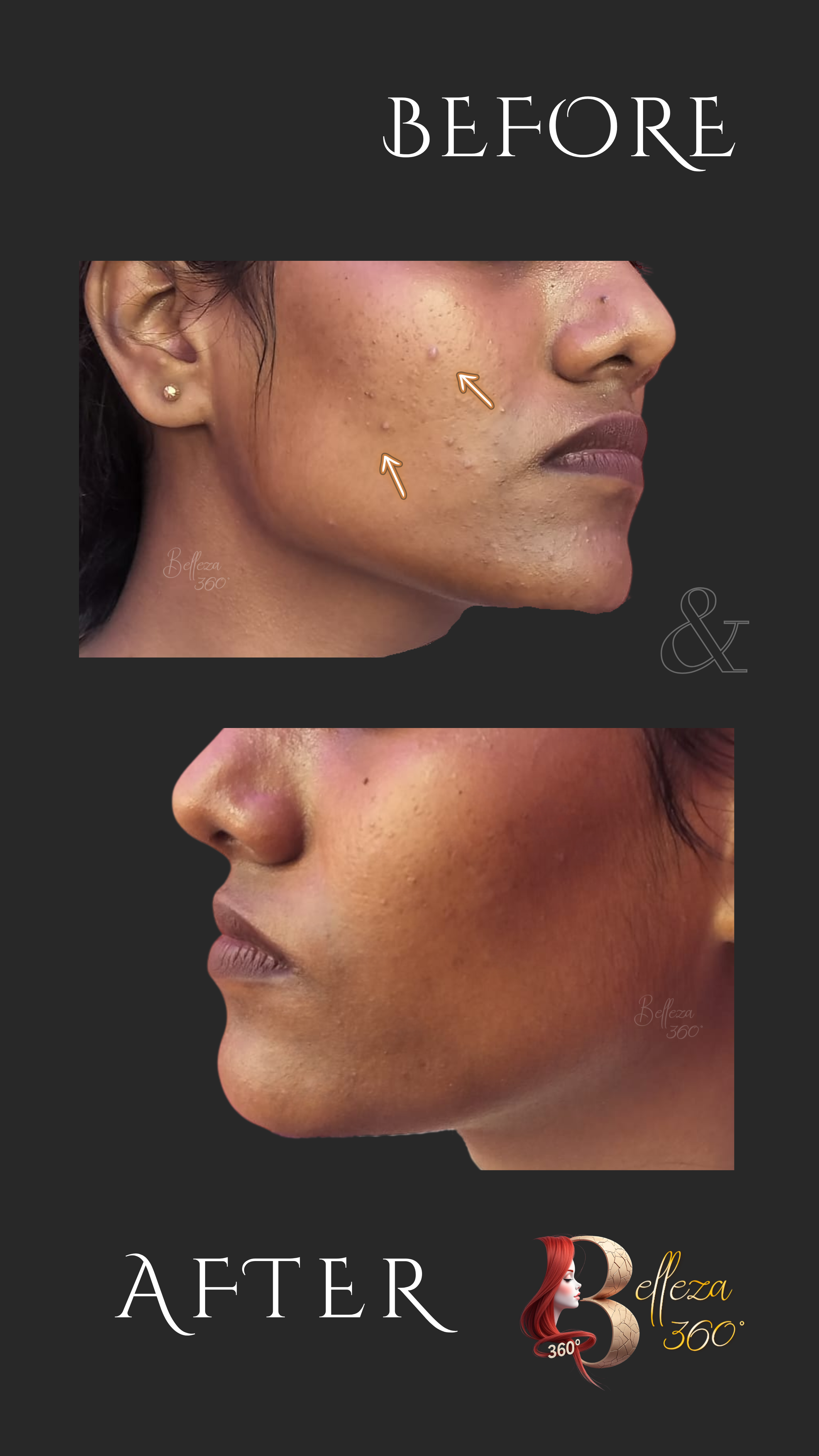 Active acne peeling Chennai, Chemical peeling for acne, Acne treatment peel, Best acne peel clinic Chennai, Skin resurfacing for acne, Acne scar prevention peel