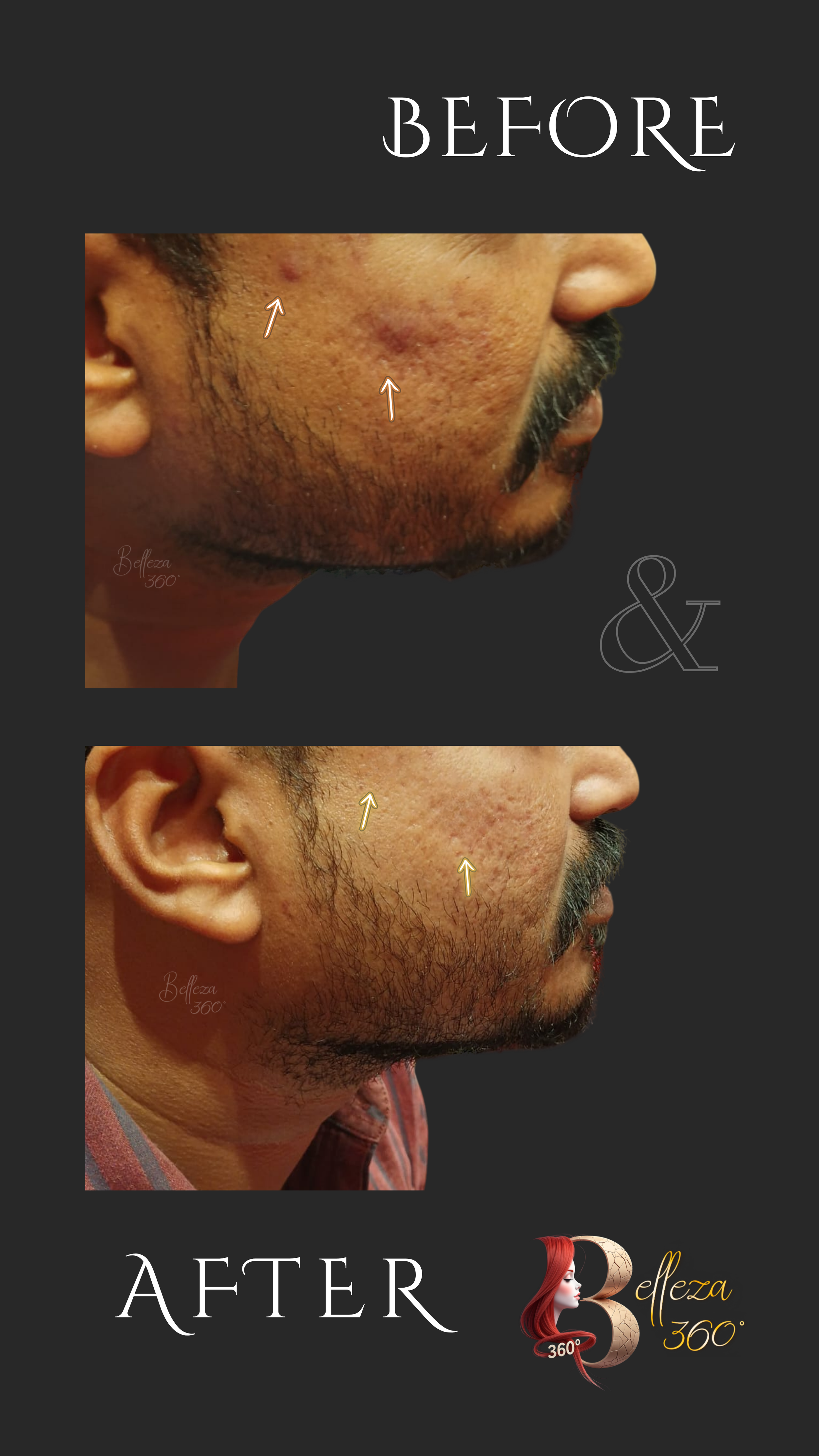Yellow Peel treatment Chennai, Face PRP therapy Chennai, Skin rejuvenation Chennai, Pigmentation treatment Chennai, Fine line reduction Chennai, Best skin clinic in Chennai