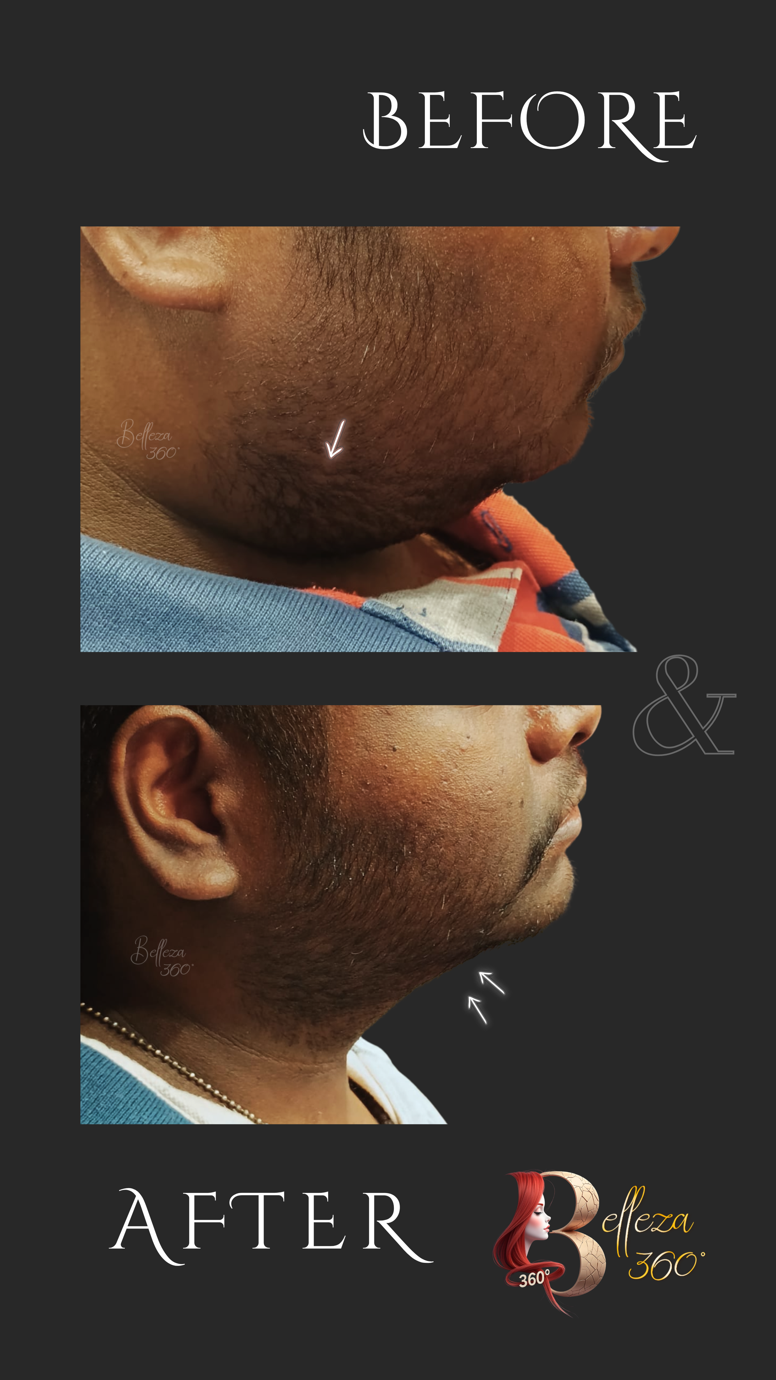 Double chin removal Chennai, Non-surgical double chin treatment Chennai, Double chin reduction clinic Chennai, Best doctor for double chin removal Chennai, Double chin fat removal Chennai, Laser double chin treatment Chennai, V-line chin treatment 