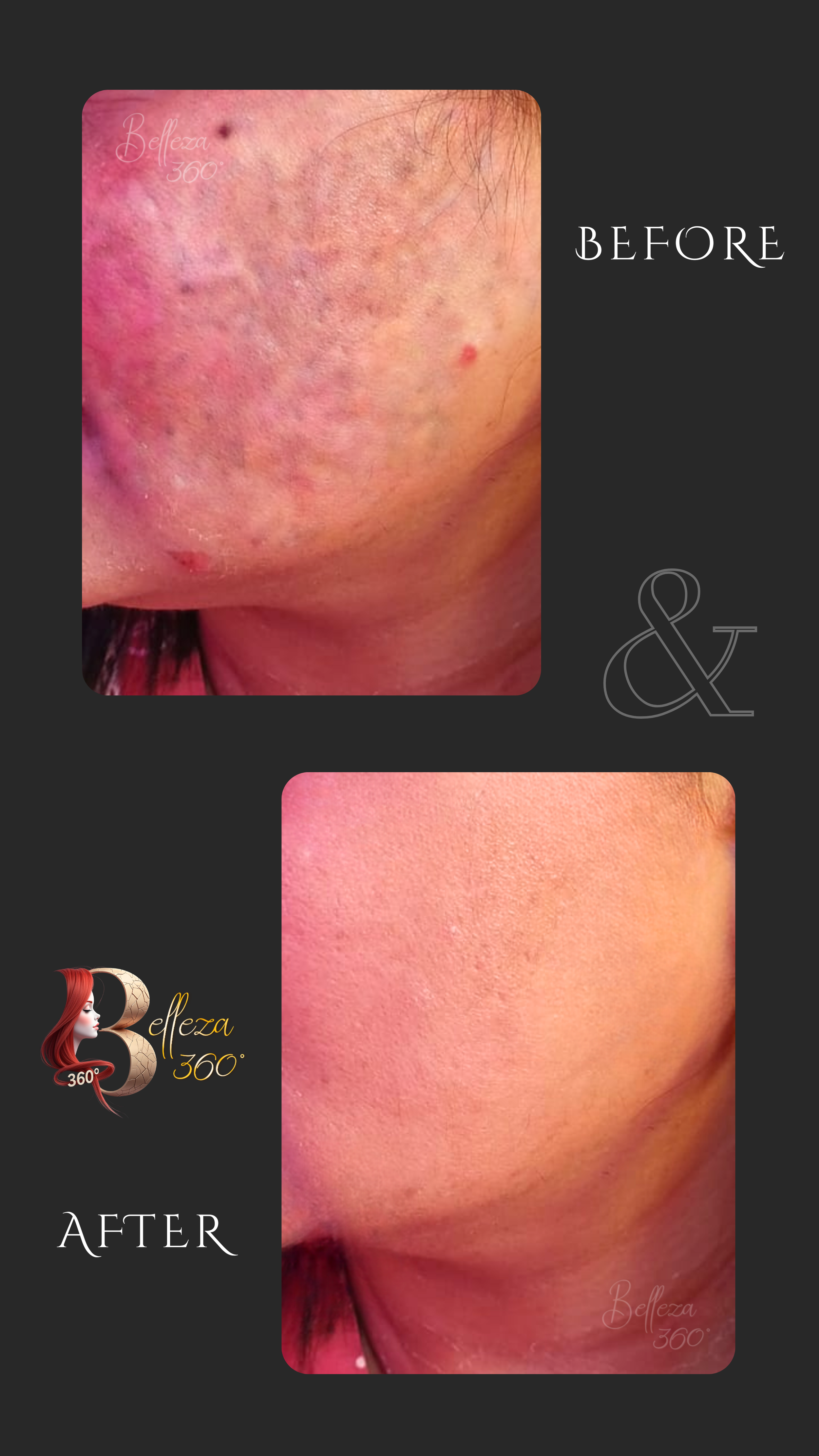 Cosmelan peel treatment, best Cosmelan clinic, Cosmelan peel for pigmentation, Cosmelan peel for dark spots, dermatologist for Cosmelan peel, Cosmelan skin brightening treatment