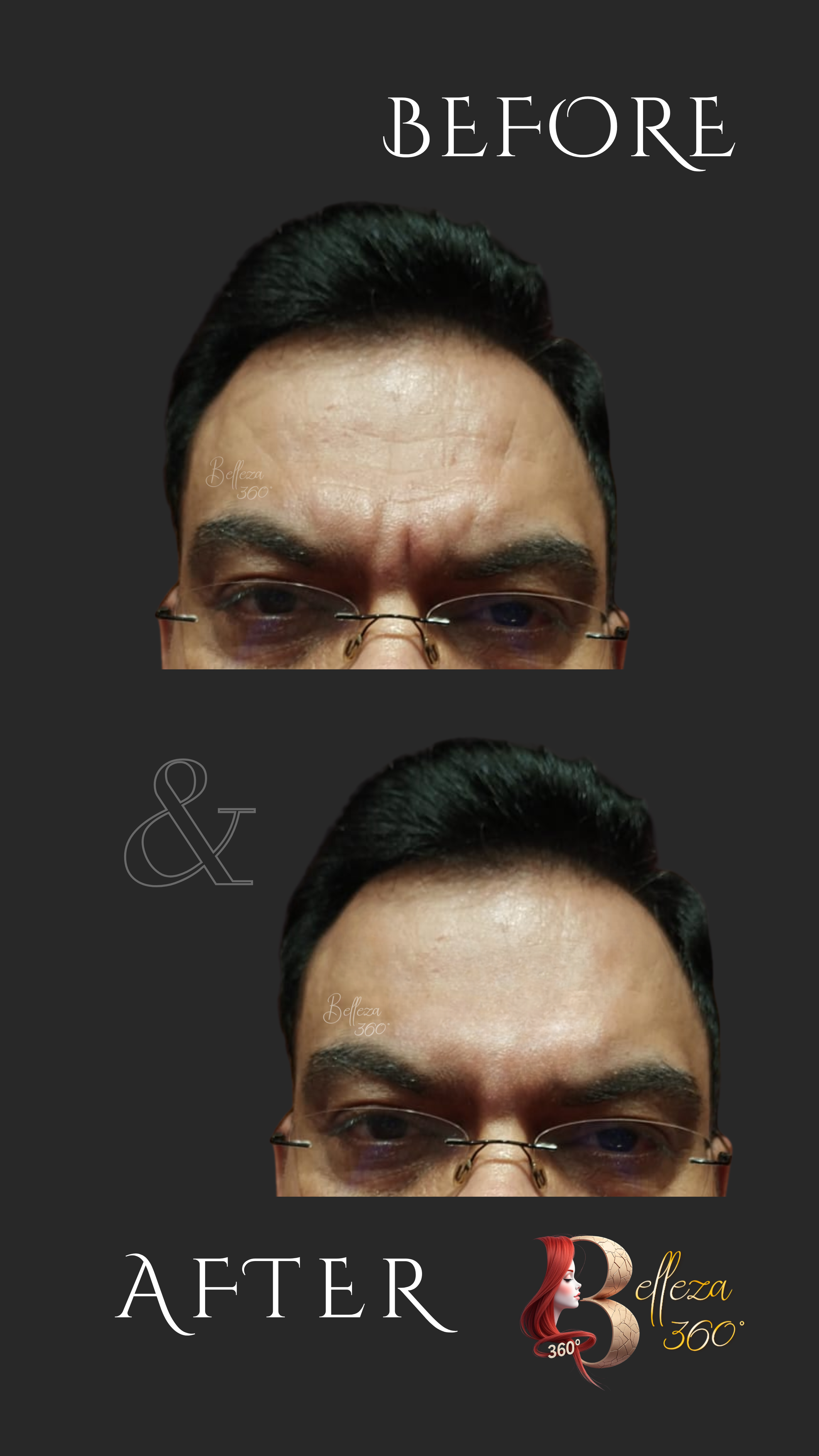 forehead wrinkle removal treatment, best forehead wrinkle clinic, forehead wrinkle reduction, Botox for forehead wrinkles, dermatologist for forehead wrinkles, non-surgical forehead wrinkle treatment