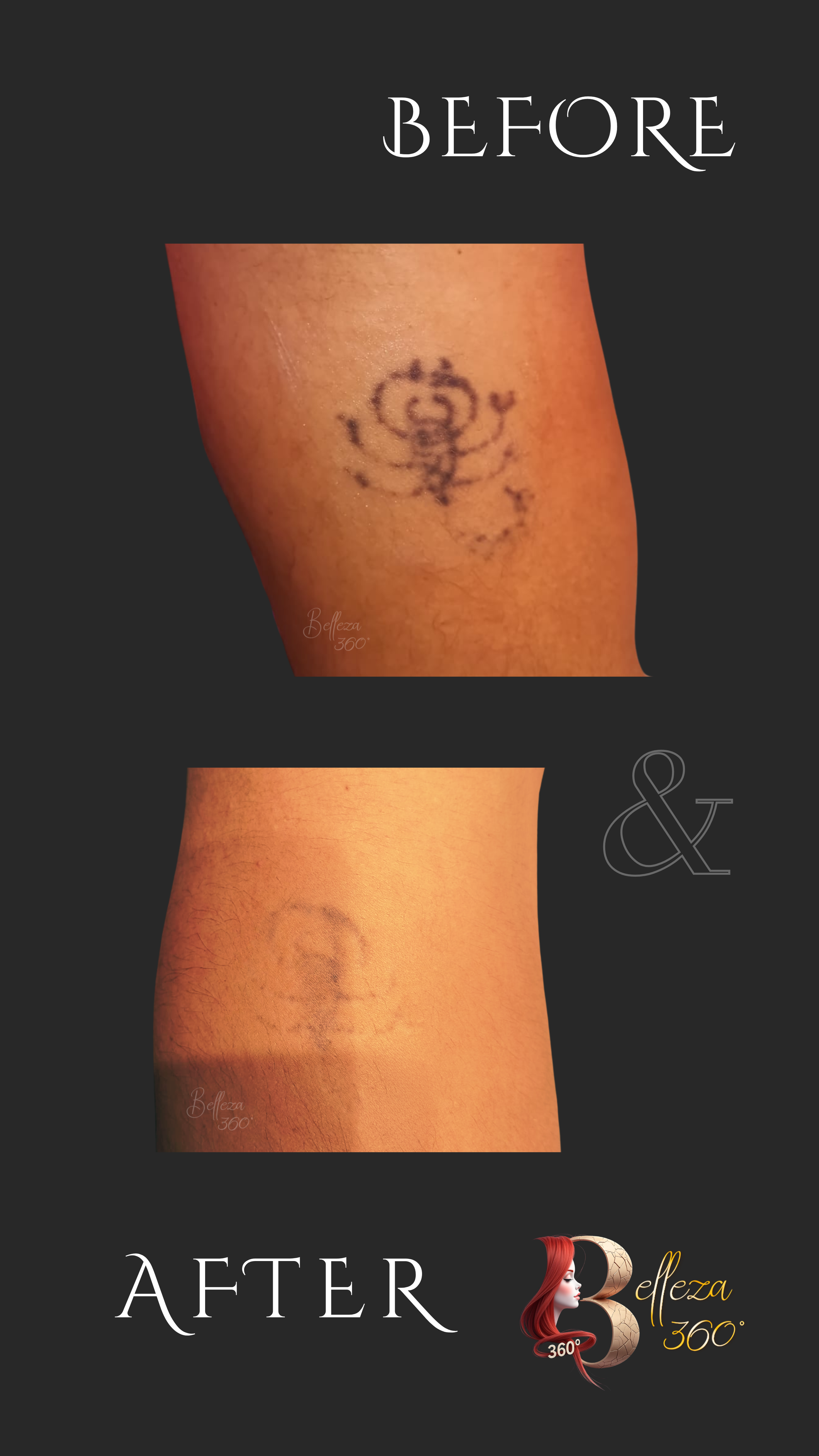 laser tattoo removal, tattoo removal clinic Chennai, laser tattoo removal treatment, permanent tattoo removal, advanced laser tattoo removal, cosmetic laser clinic Chennai