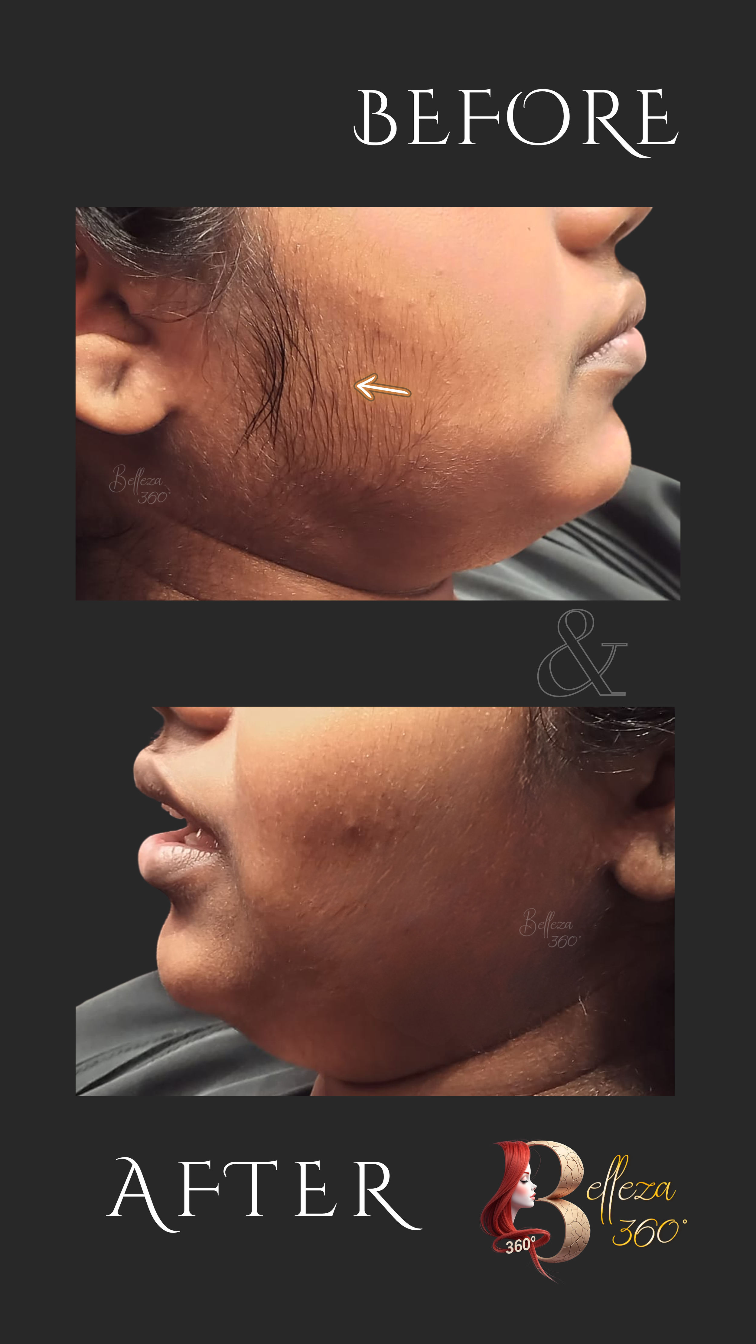 Dermaplaning treatment, Dermaplaning facial near me, Dermaplaning skin exfoliation, Best dermaplaning clinic, Dermaplaning for smooth skin, Professional dermaplaning treatment