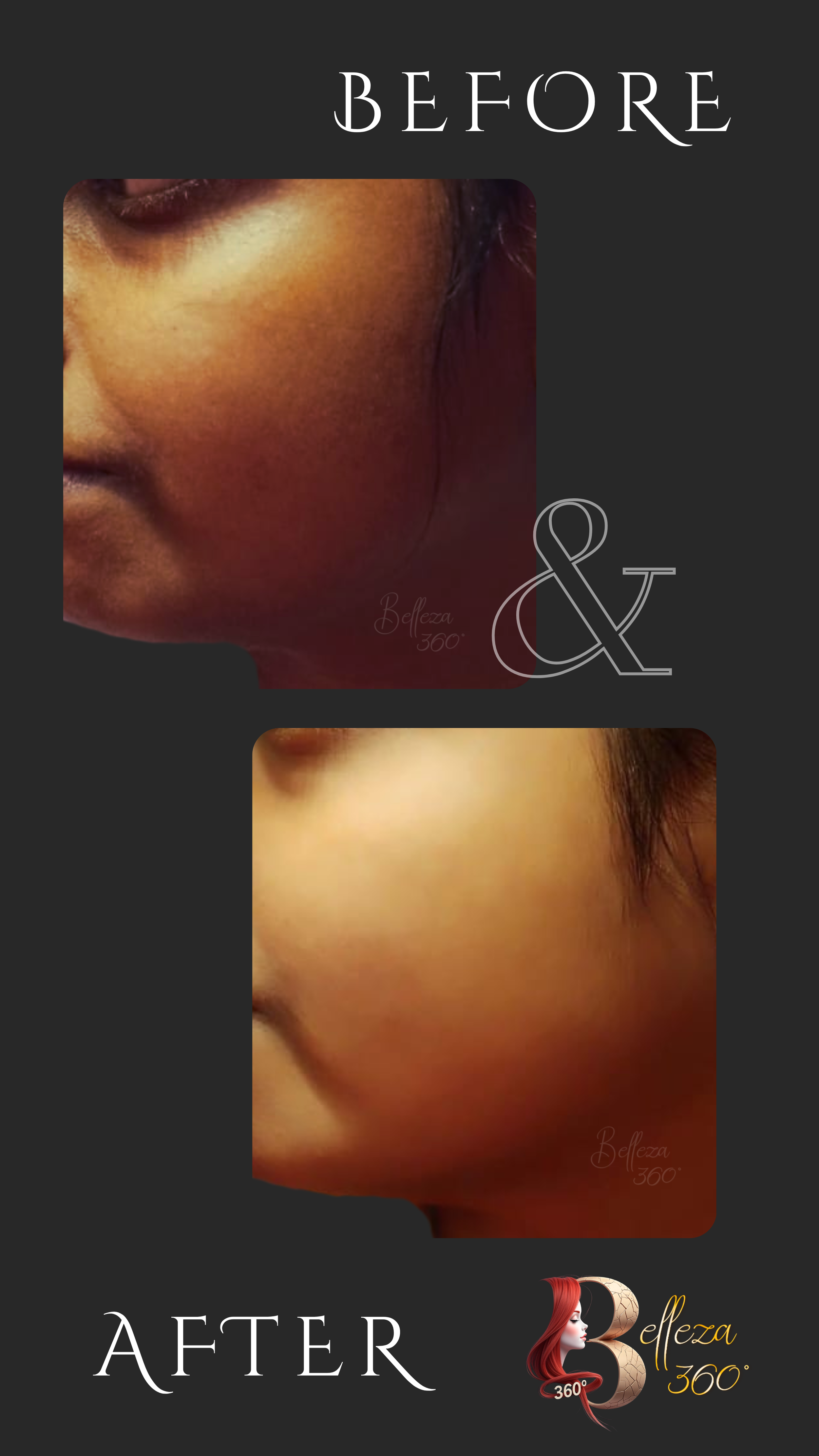 Carbon laser peel in Chennai, Best carbon laser peel clinic in Chennai, Carbon laser facial treatment Chennai, Carbon peel for glowing skin Chennai, Carbon laser peel cost in Chennai, Painless carbon laser peel Chennai