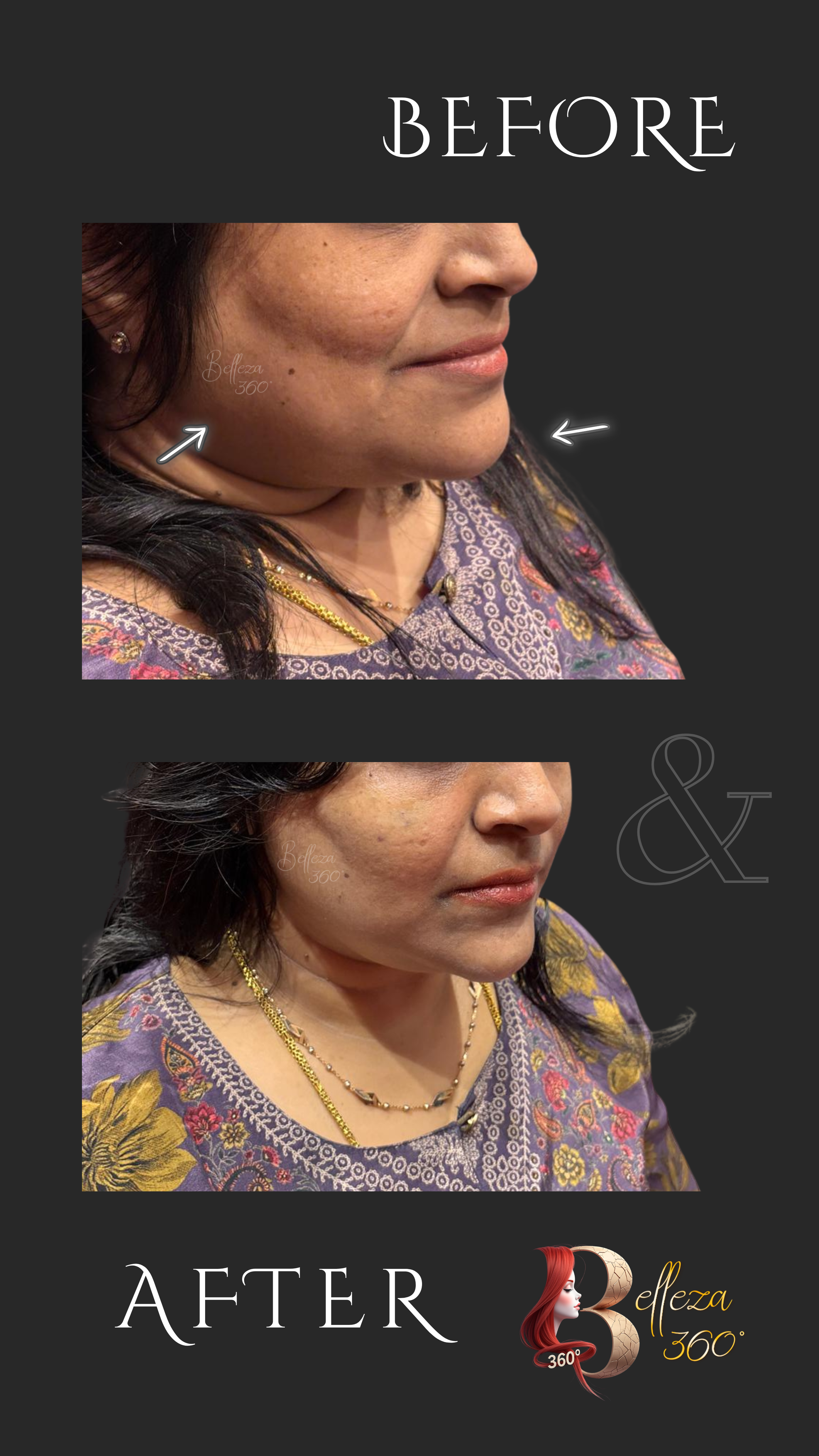 Jawline Ultraformer HIFU in Chennai, HIFU jawline lifting Chennai, Non-surgical jawline contouring Chennai, Ultraformer HIFU skin tightening Chennai, Jawline HIFU treatment cost Chennai, Best Ultraformer HIFU clinic Chennai