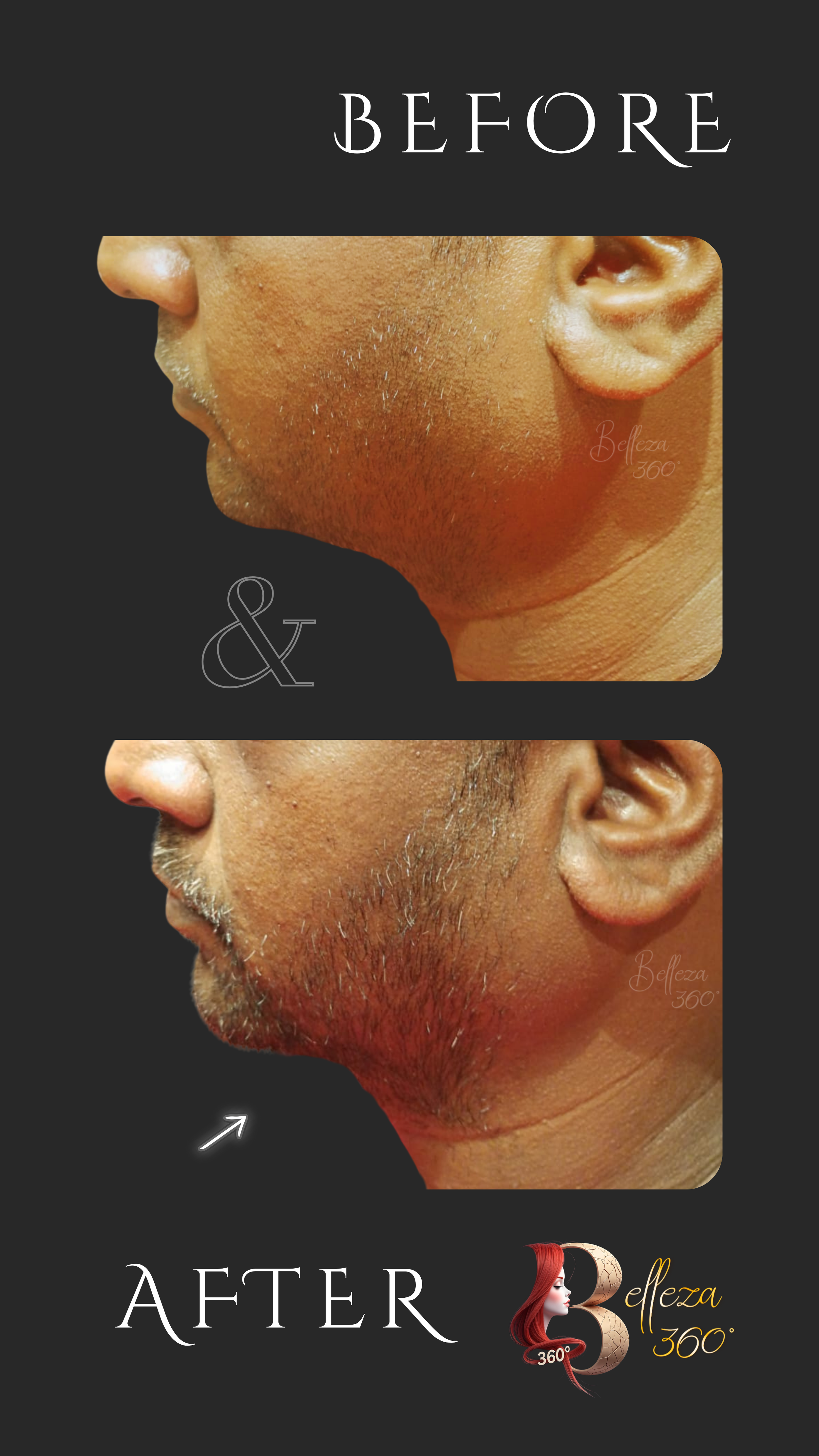 Morpheus 8 jawline tightening in Chennai, Morpheus8 jawline treatment Chennai, Non-surgical jawline tightening Chennai, Morpheus 8 skin tightening clinic in Chennai, Morpheus 8 jawline contouring Chennai, Morpheus 8 jawline tightening cost in Chennai
