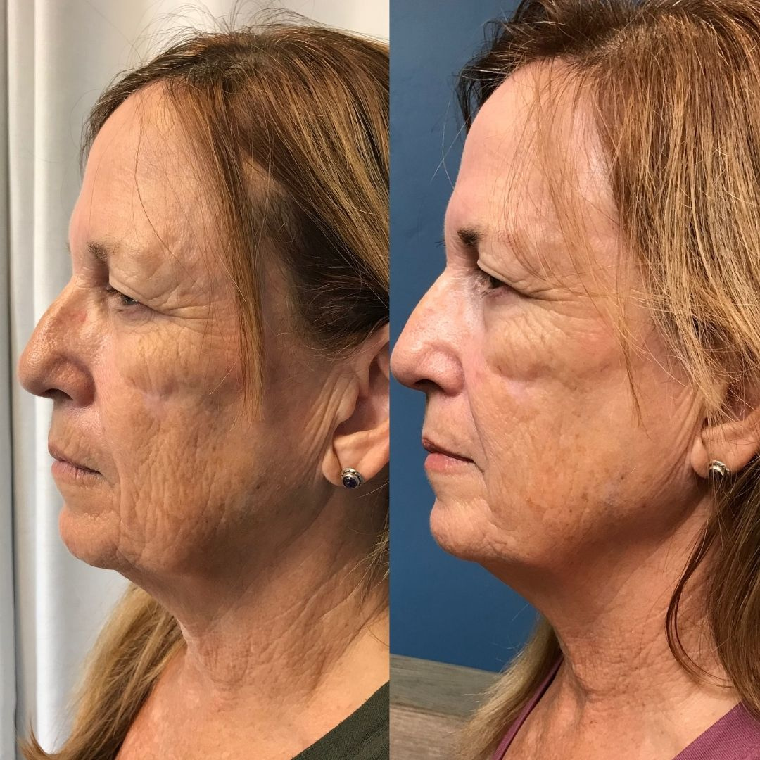 Red light therapy for skin tone and texture improvement