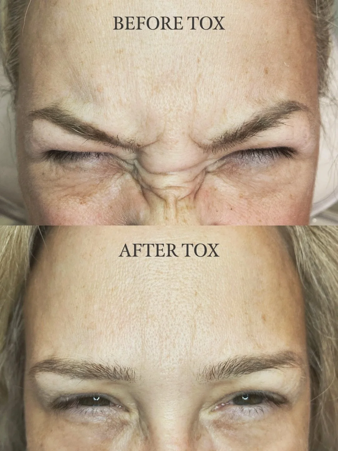 DYSPORT!

That&rsquo;s all. Dysport. Dysport is the best. Smooth foreheads 4 lyfe ✌🏻

&bull;
&bull;
&bull;

#KindredYYC  #InglewoodYYC #CalgaryNurseInjector #YYCInjectables #YYCBotox