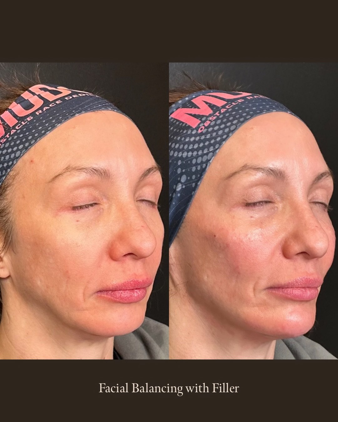 Cheeks + chin + jaw = structure, balance, and keeping it all looking natural.

If you&rsquo;re wondering if you&rsquo;re a good candidate for a treatment like this, that&rsquo;s exactly what consultations are for. We&rsquo;ll figure it out together. 