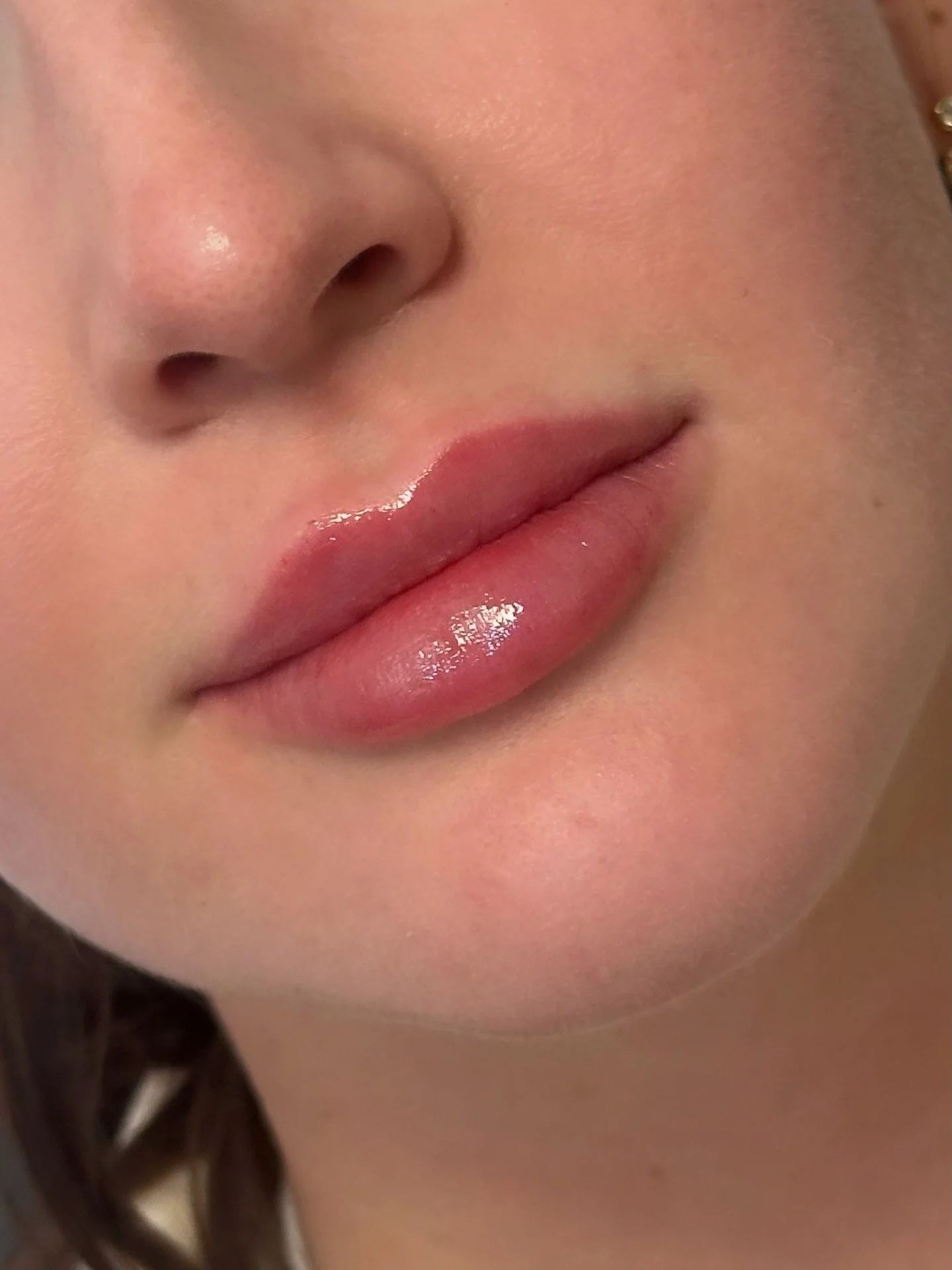 This client isn&rsquo;t new to lip filler - she gets a touch-up every 9-12 months to maintain them. For this treatment, we added just enough to restore definition and a liiiiittle bit of subtle volume. 

[Photo shared with client consent.]

.
.
.

#C