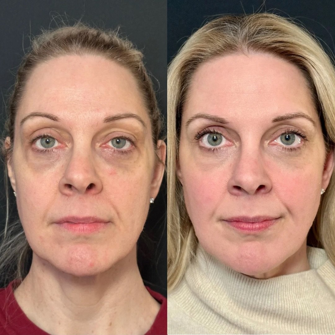 A little can go a long way.

Restoring structure in the right places can make someone look brighter and more rested without looking &ldquo;done.&rdquo;

In this case: 2 syringes of filler and a little Dysport.

Photos: before treatment &rarr; 1 month