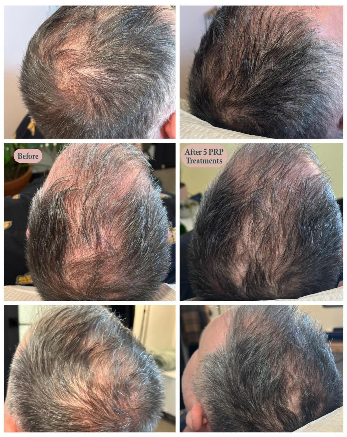 PRP Hair Treatment