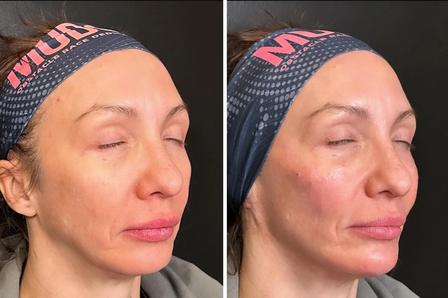 Chin, Cheeks & Jaw Filler