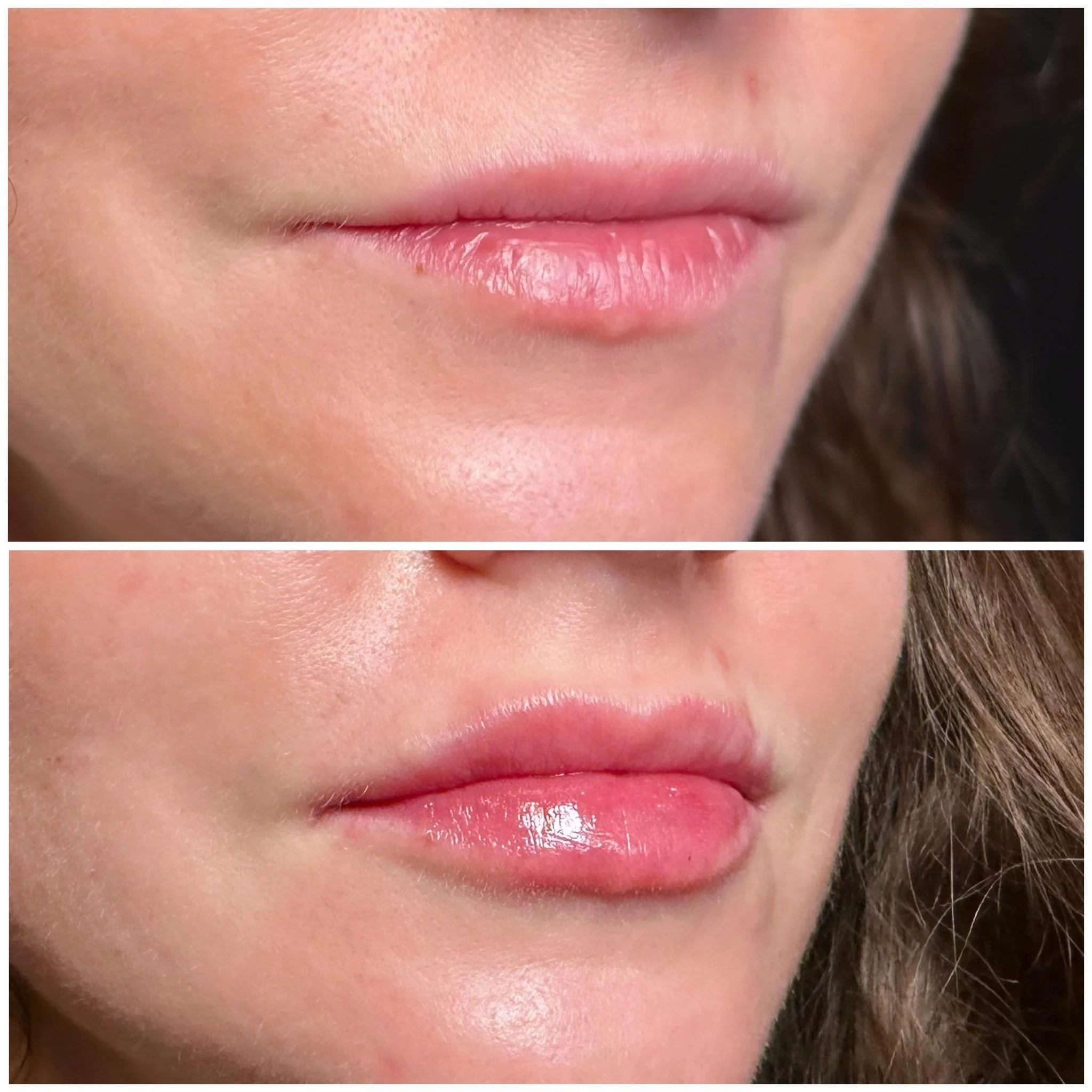 Lip Filler