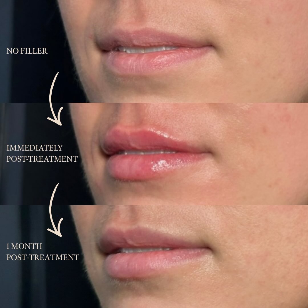 Lip Filler