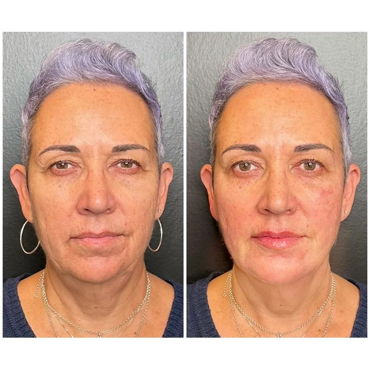 Lower-Face Rejuvenation & Mini Lip