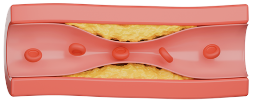 #19: Atherosclerosis &amp; Why ApoB Matters