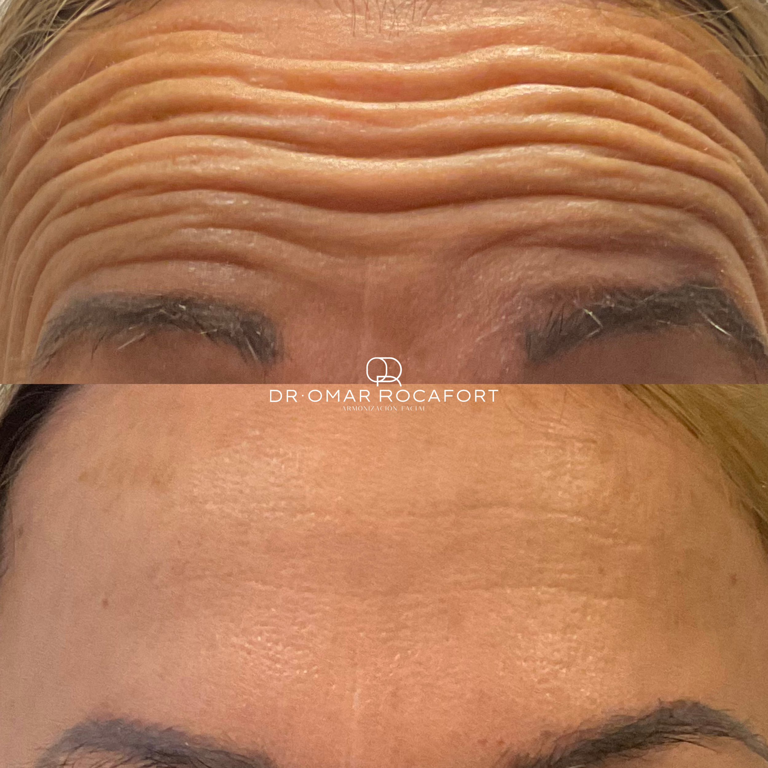 Dr. Omar Rocafort | Armonización Facial
