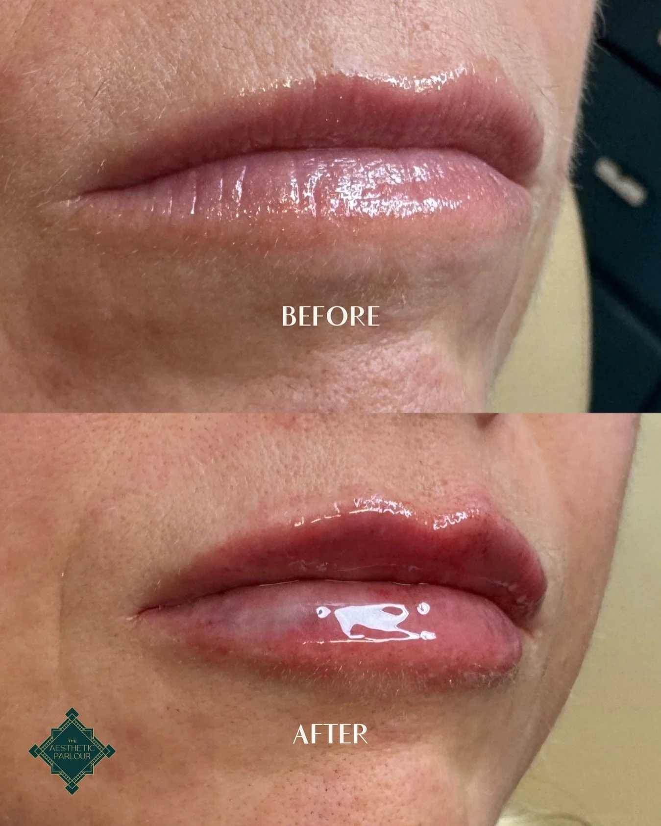Have you started to noticed those little lines starting to appear on your lips?!

This is actually a natural sign of aging! As we lose collagen and hydration, lips can look thinner, less plump, and those fine lines become more noticeable.

*Lip fille