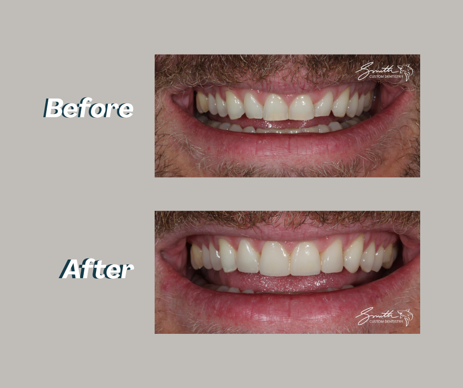 Advanced Restorative - Smile Makeover - Before and After - DK - Esthetic bonding.png