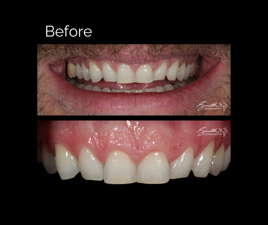 Smile Makeover - Esthetic Bonding - Before