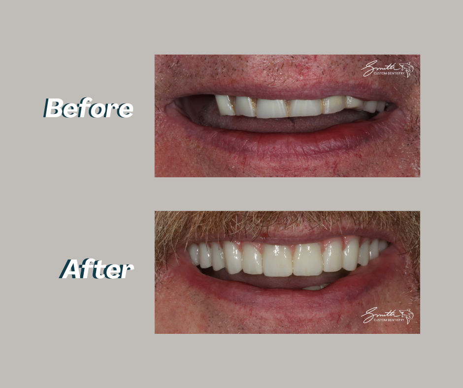 Advanced restorative - All on X fixed implant denture 2 - smile before and after - kb.png