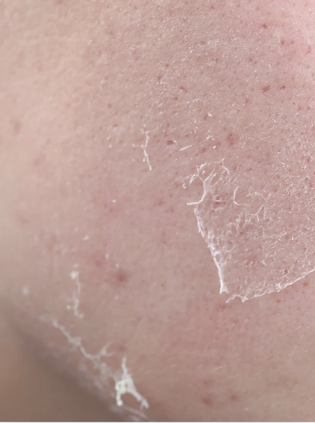 Dry vs. dehydrated skin 